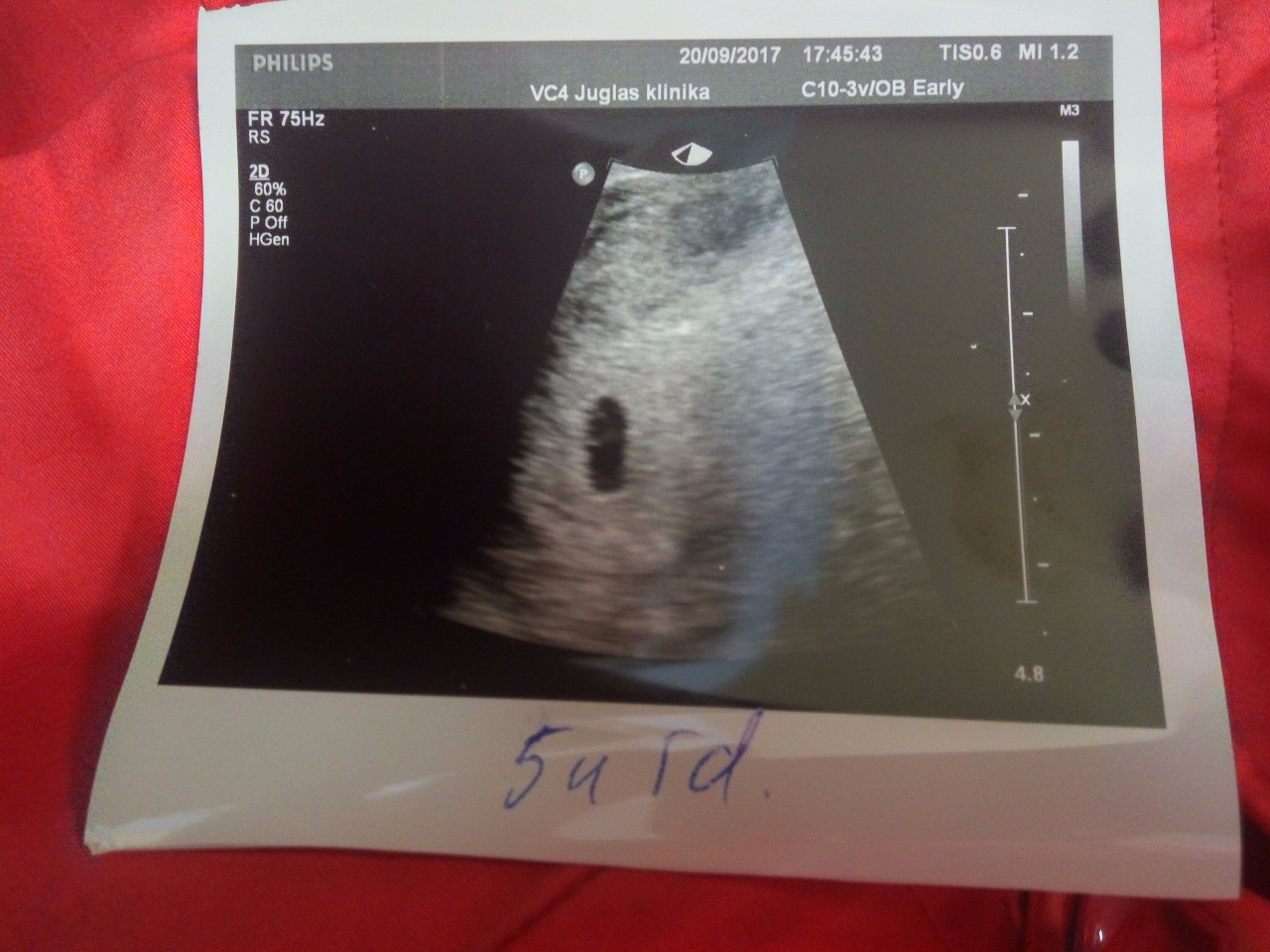 Снимок УЗИ беременности 4-5 недель
