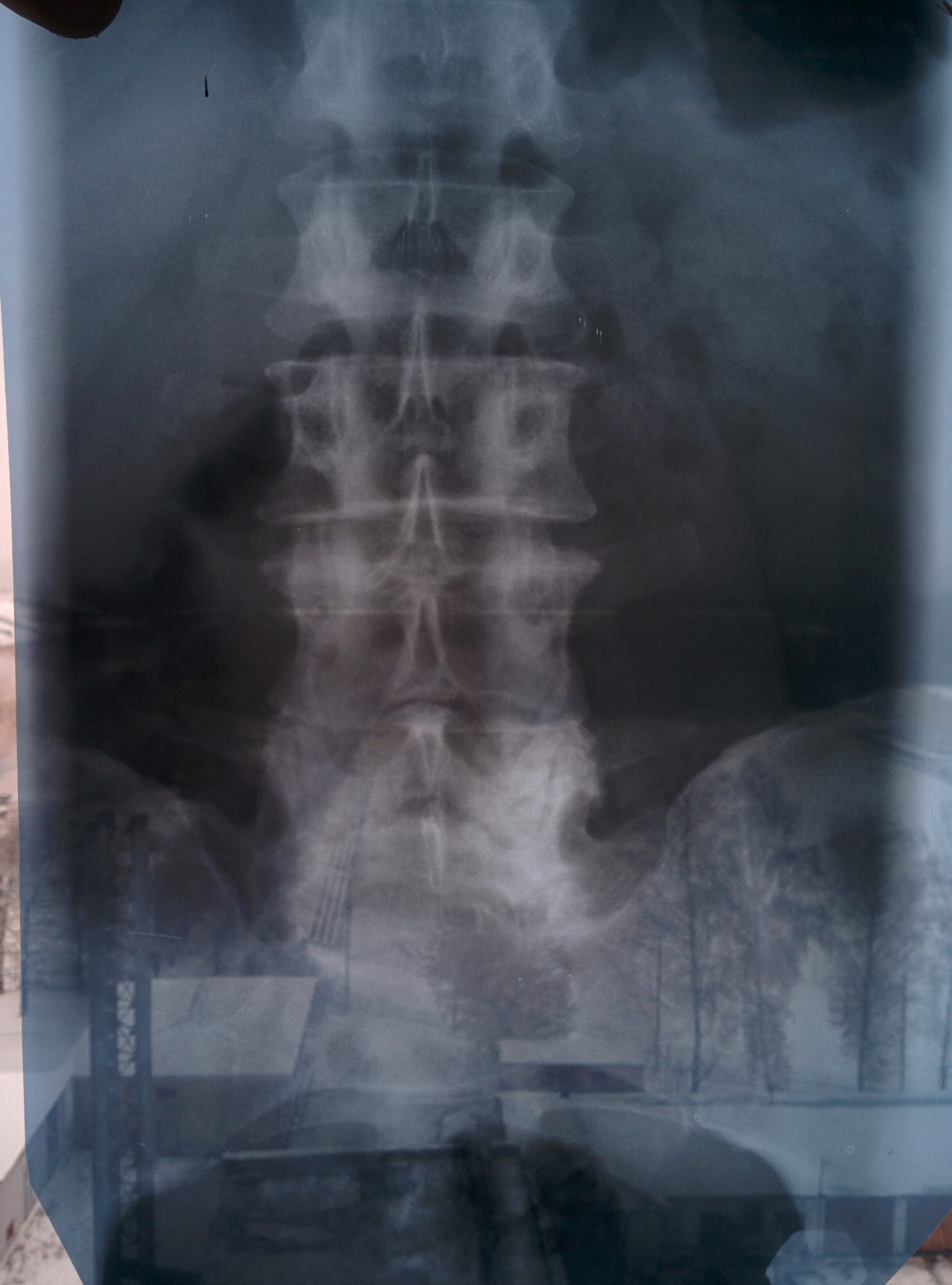 Грыжа позвоночника на рентгене фото