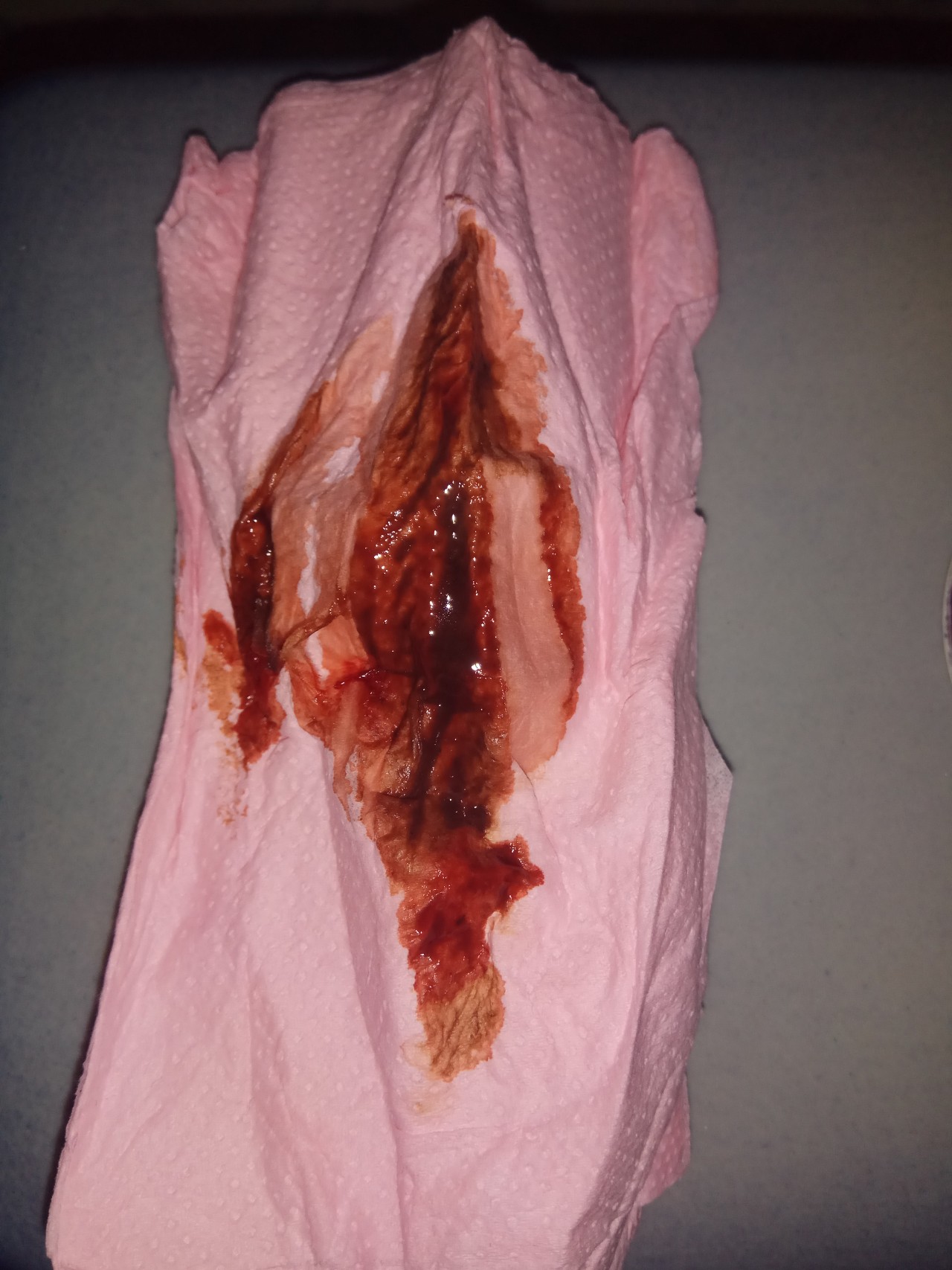 коричневые выделения из груди при беременности фото 12