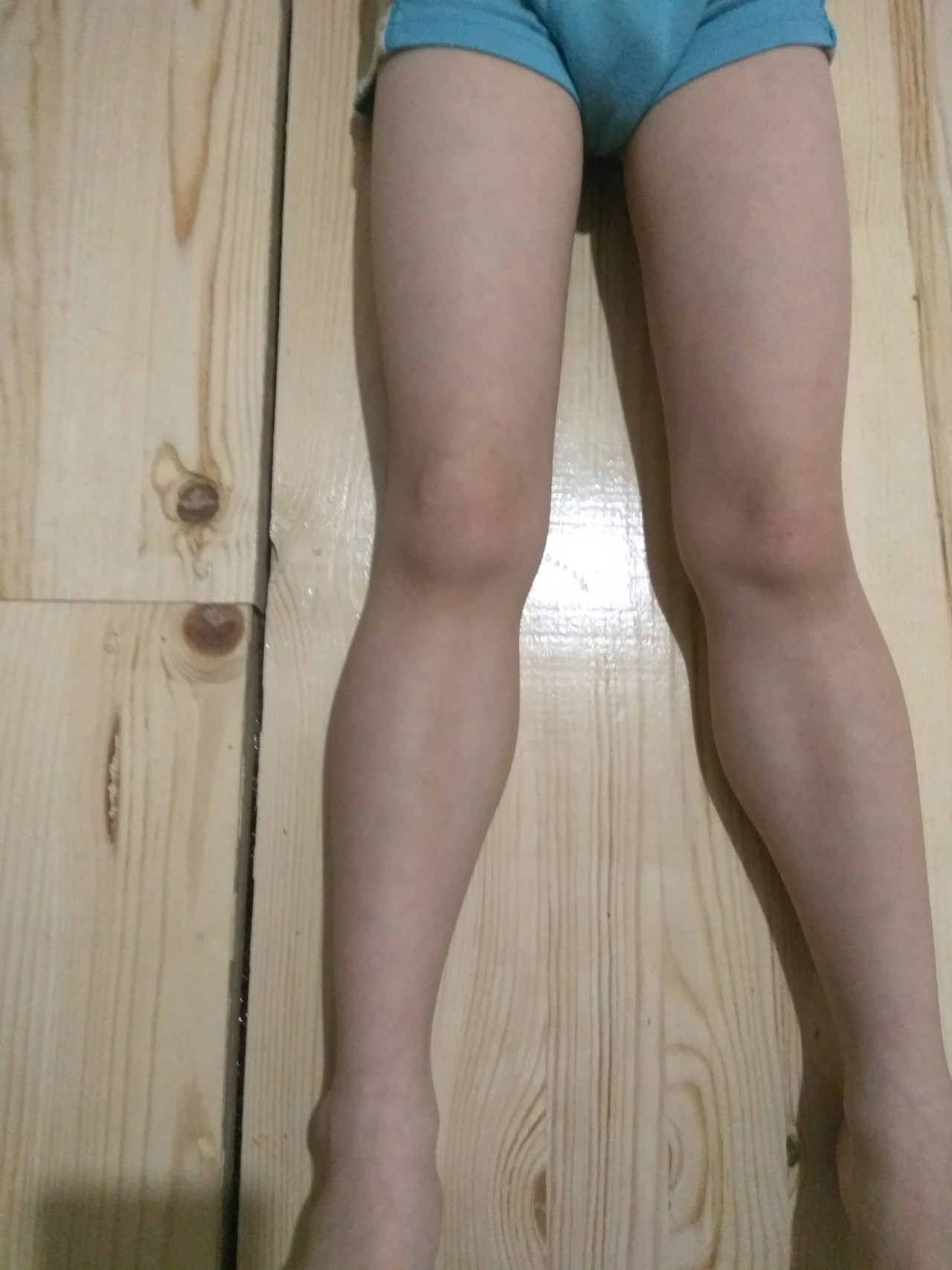 Кривые ноги в коленках