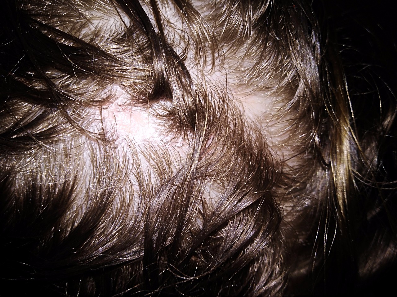 Волос выпадает пятнами. Выпали волосы на голове пятном у ребенка. Пятна с выпадением волос у ребенка.