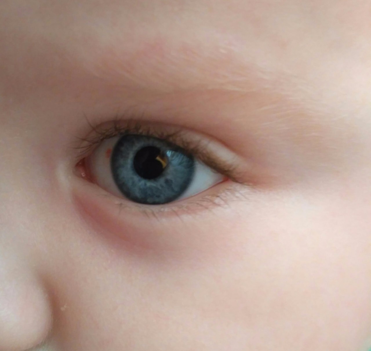 Красное пятно на глазу у ребенка