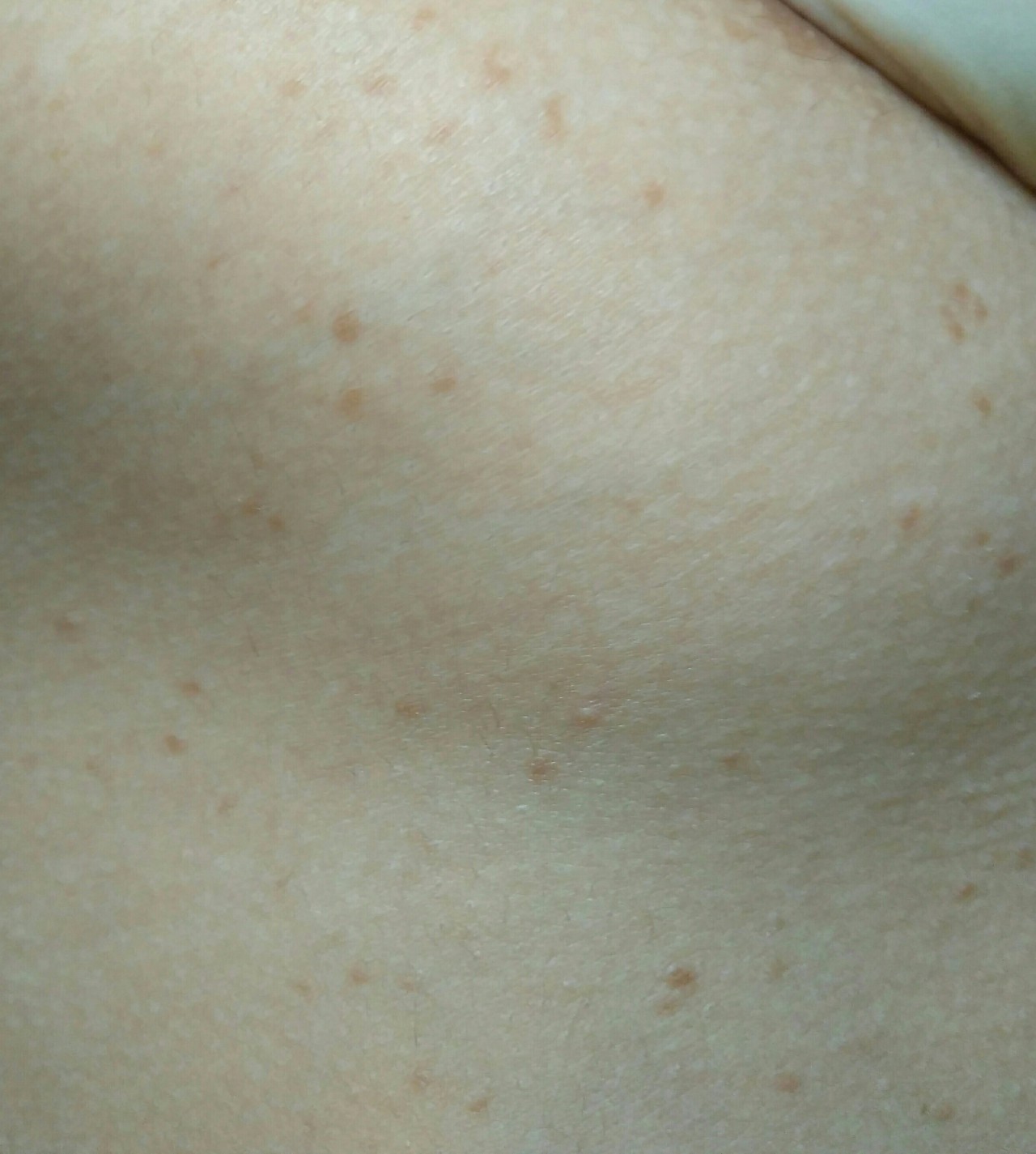 светлые пятна на груди женщин фото 17