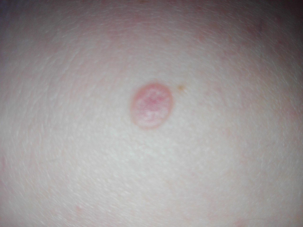 появилось красное пятно на груди при беременности фото 26