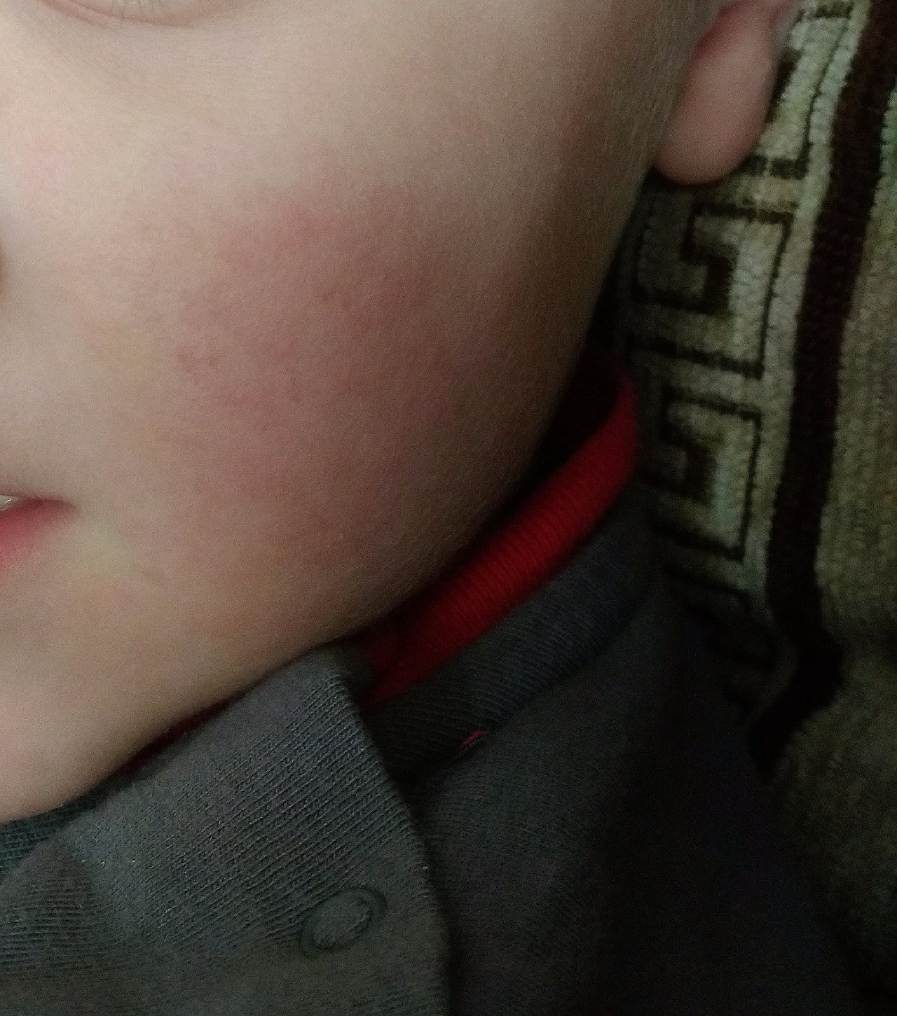Капилляры на щеках у ребенка