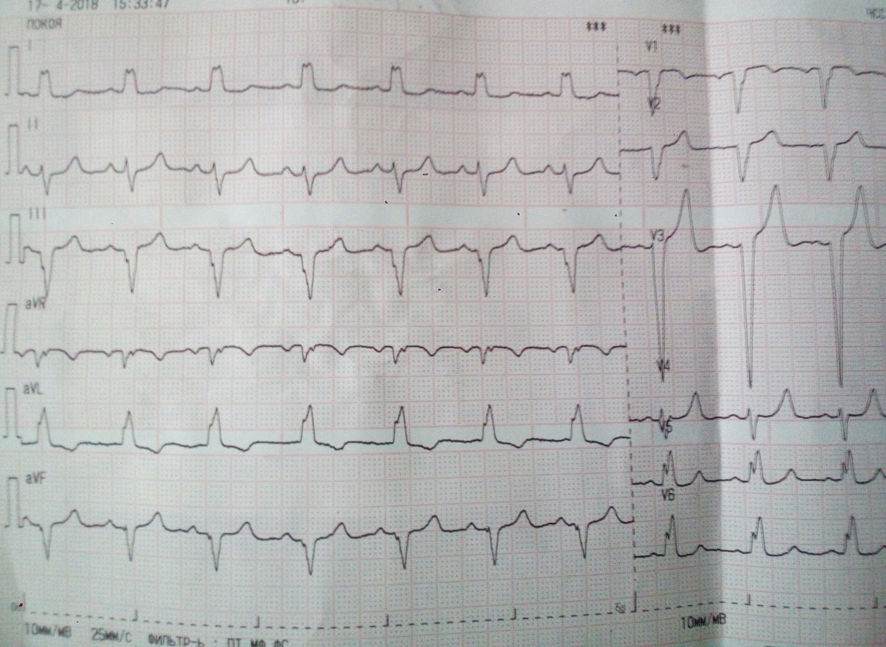 ЭКГ снимки инфаркта миокарда