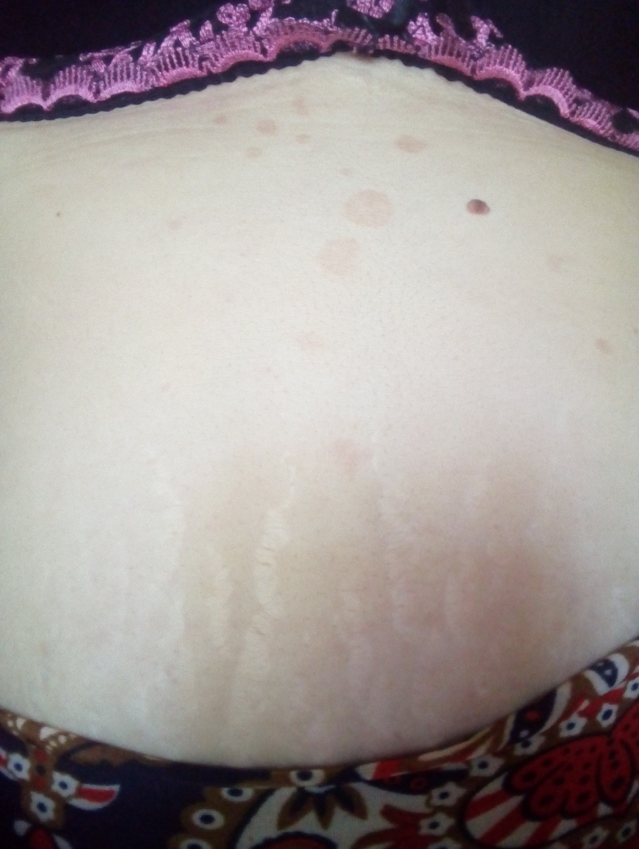 коричневые пятна на груди беременность фото 2