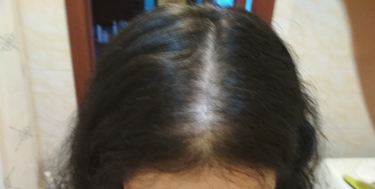 Выпадение волос в нижнем тагиле