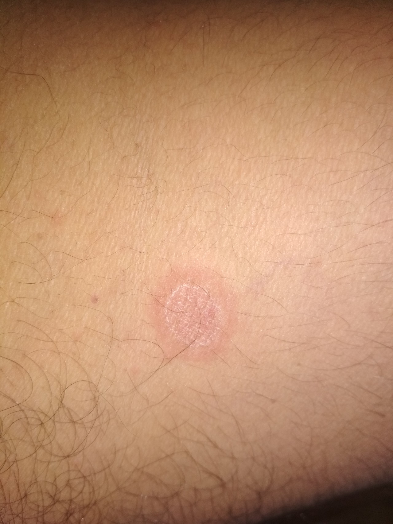 Красная точки по середине шелушится Вопрос дерматологу