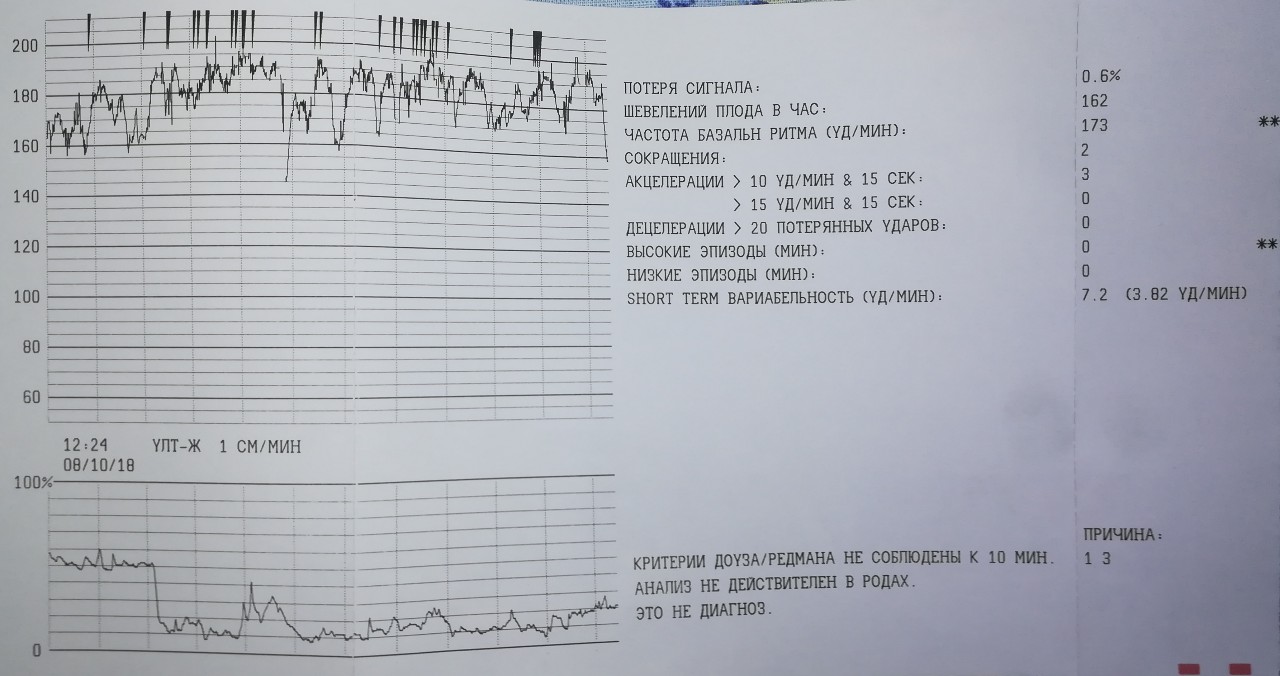 Сердцебиение плода на ктг