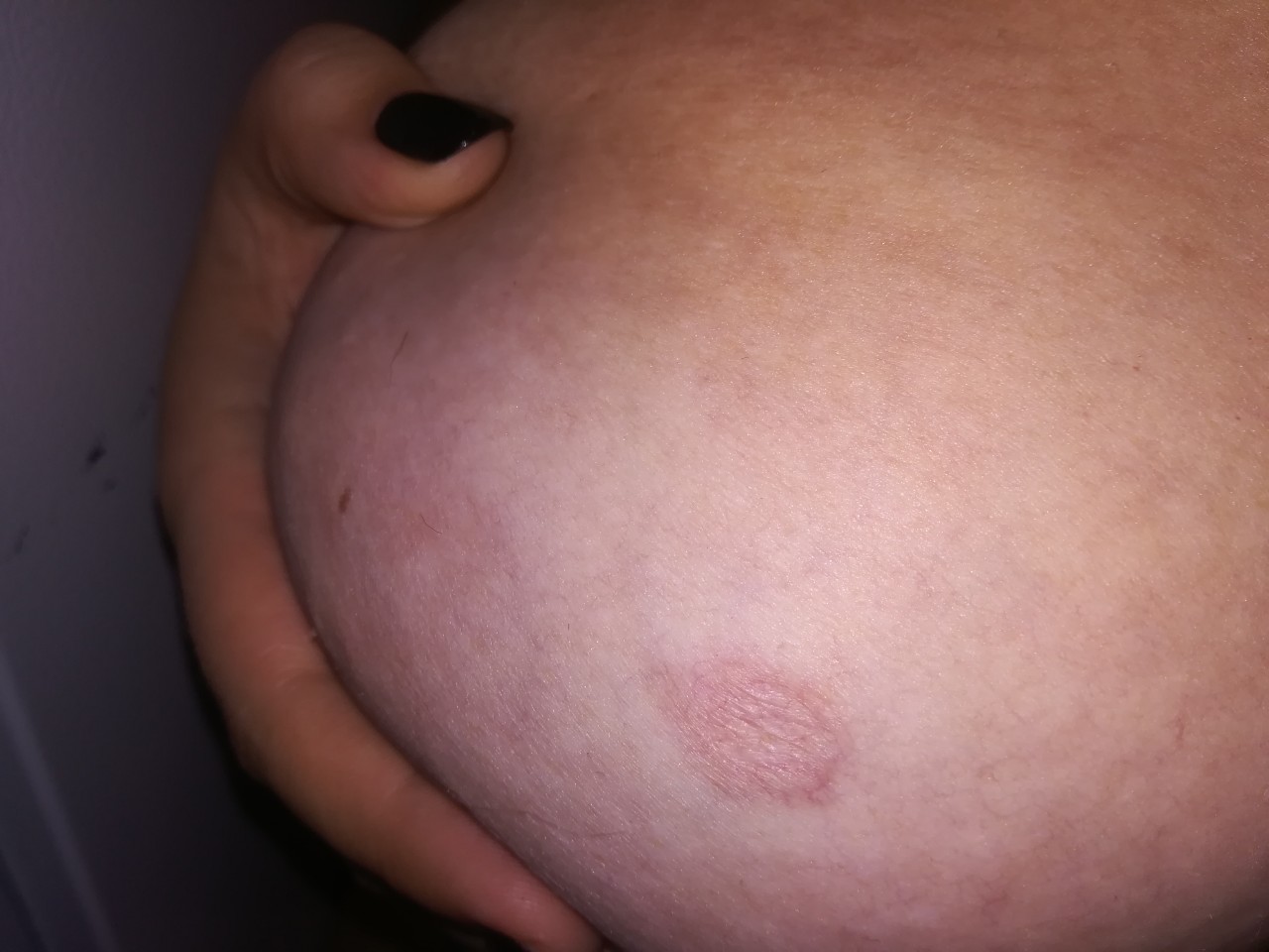 чешется пятно на груди при беременности фото 69