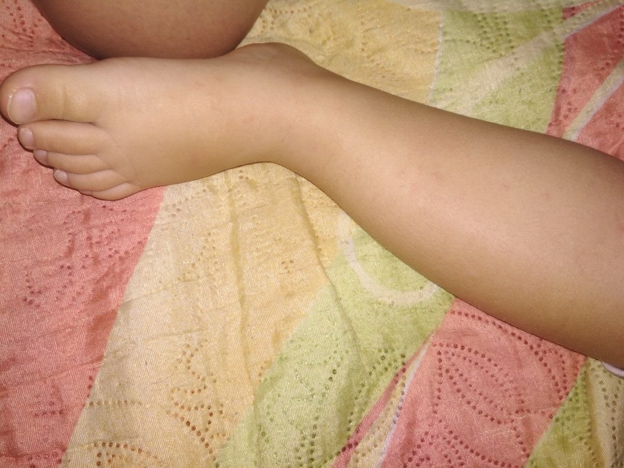 Высыпания на пальцах ног у ребенка