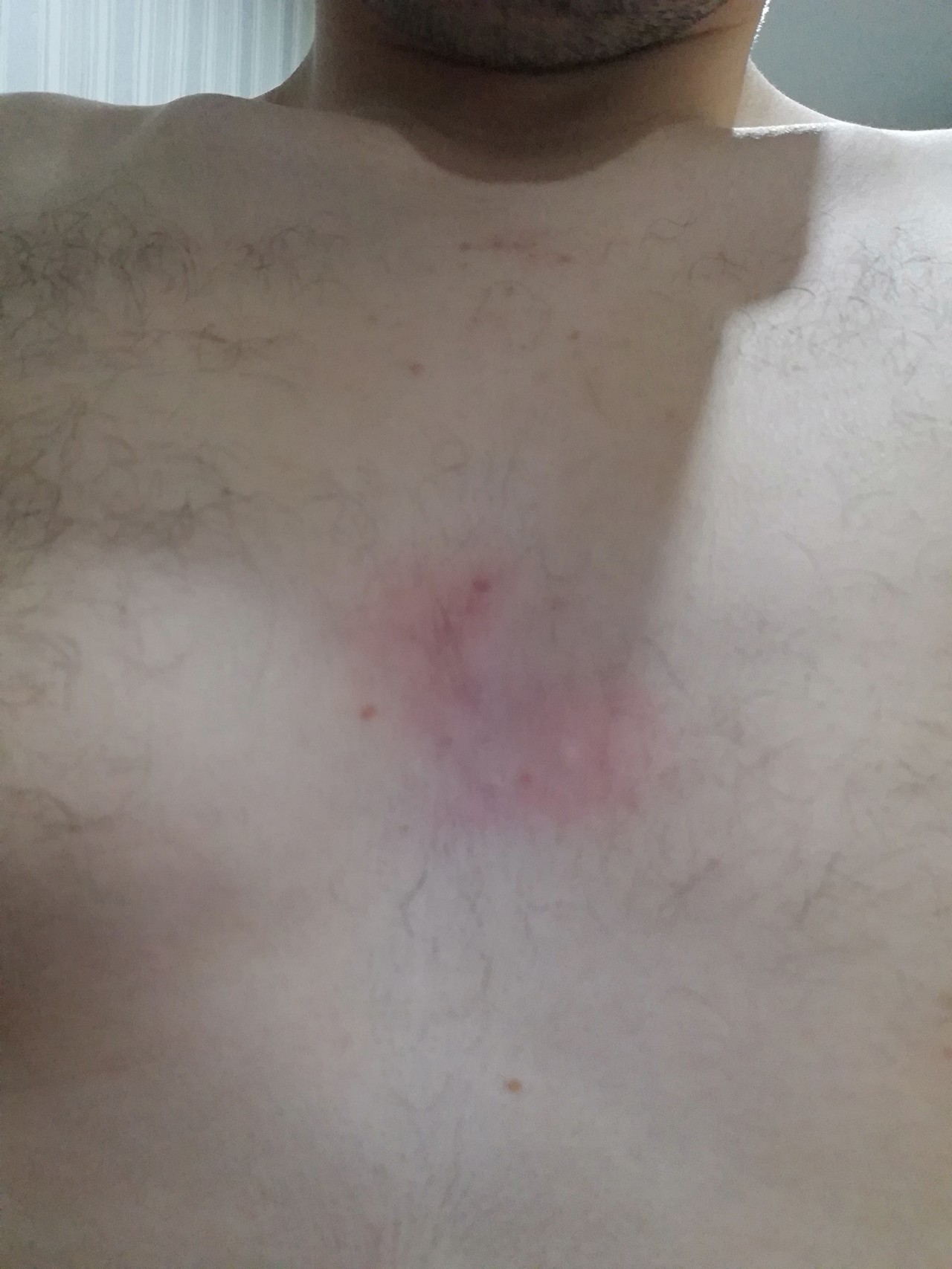 сыпь в области груди у мужчин фото 24