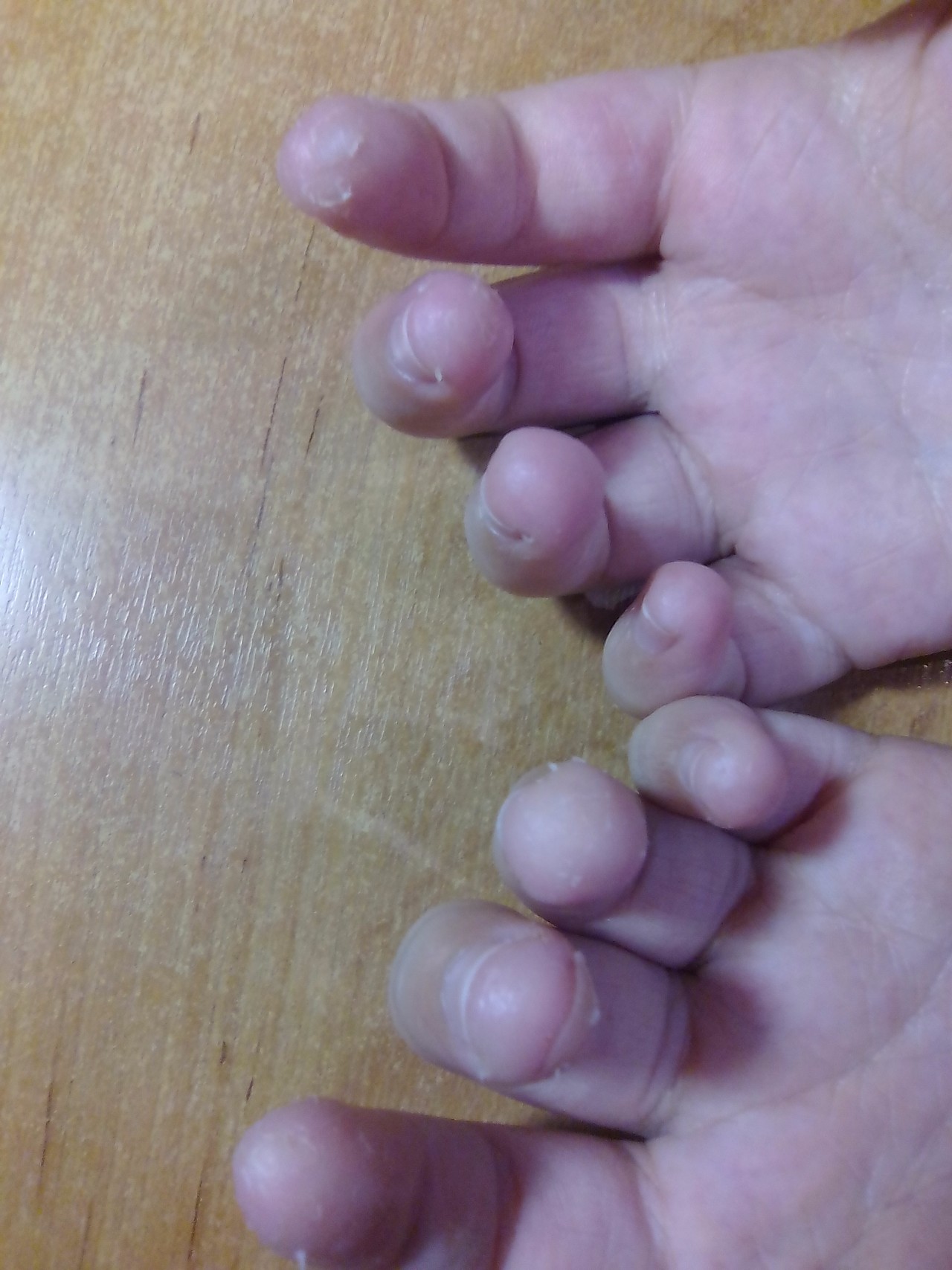 Опасны ли трещины на пальцах рук у ребенка?