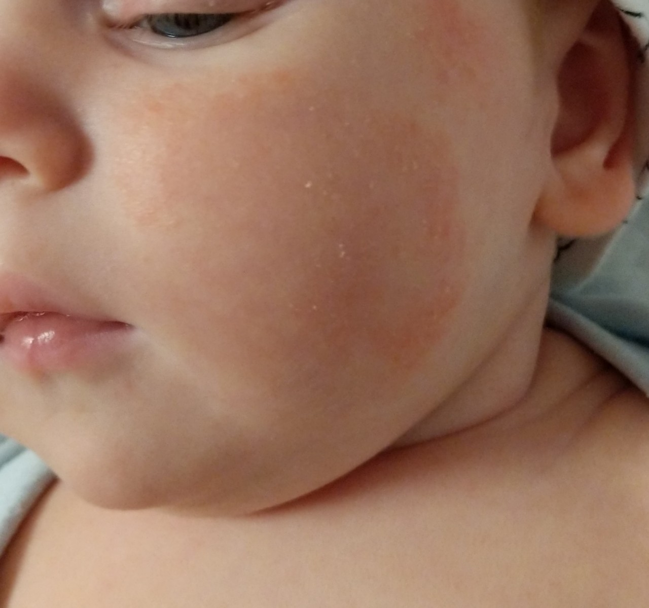 Ребенку год красные щеки. Пятна на шице у ребенек. Аллергические высыпания у ребенка на щечках.