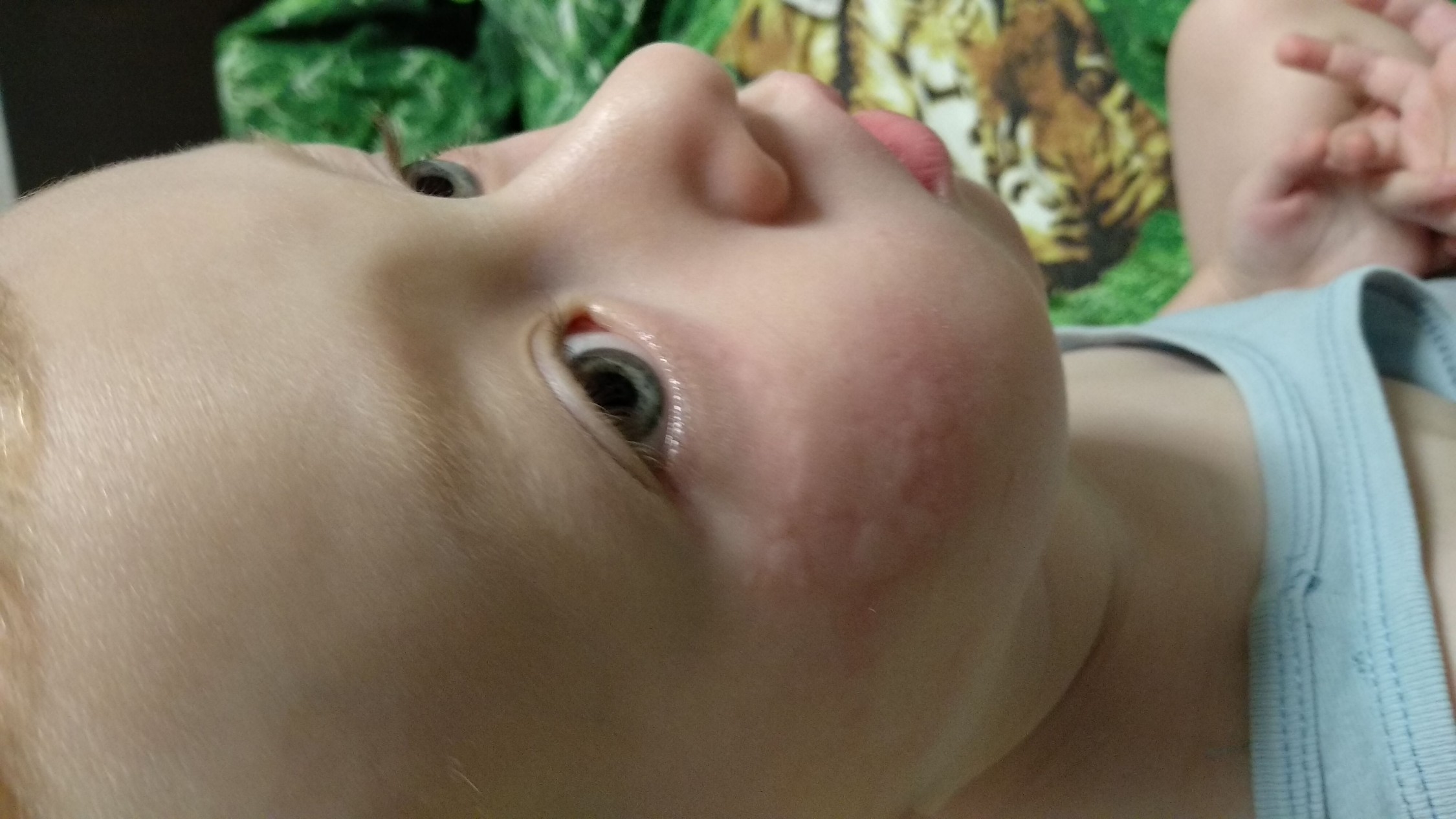 Сыпь на лице ребенка Возраст 2 года