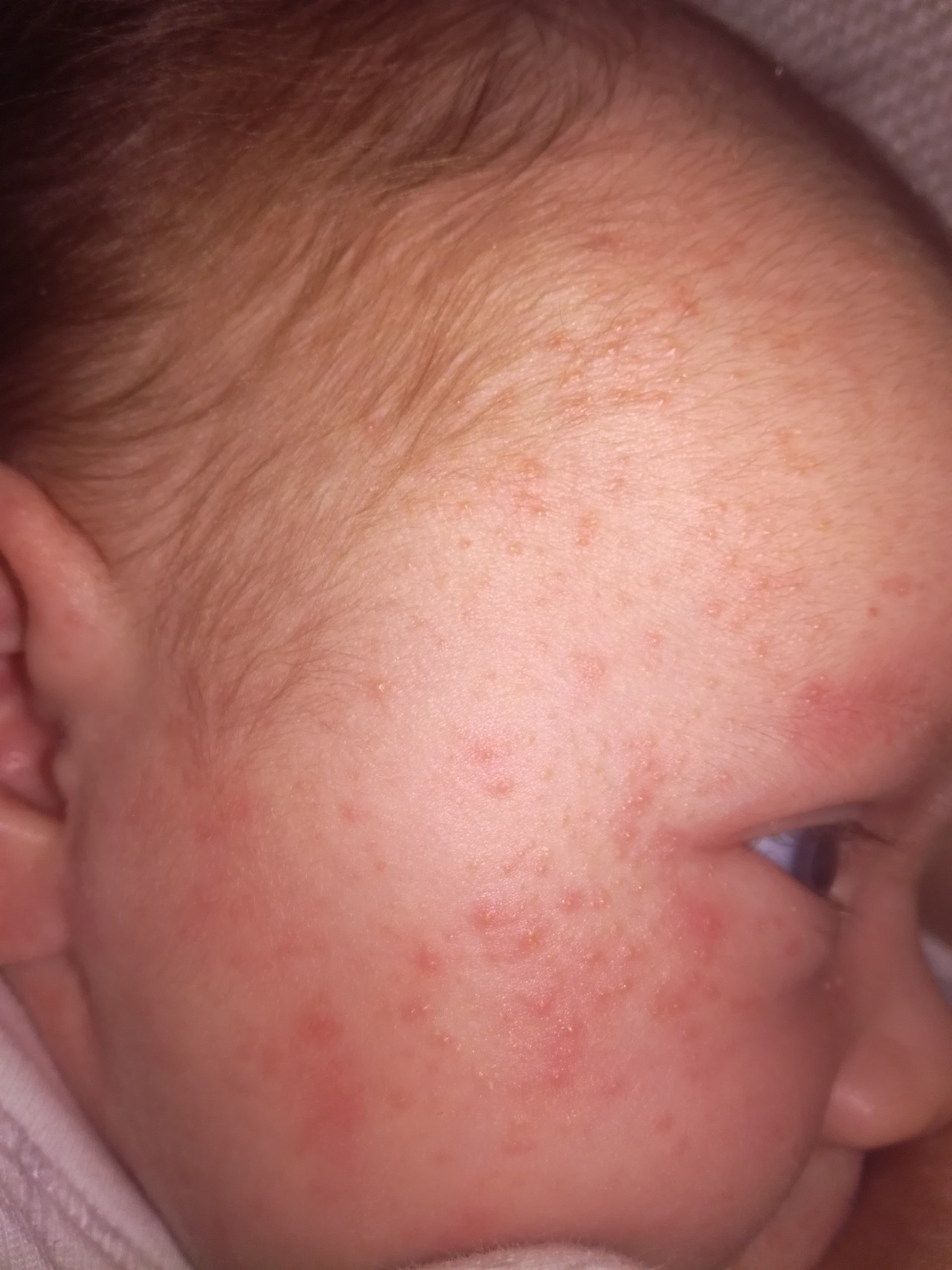 Мелкая сыпь у ребенка по всему телу без температуры с фото
