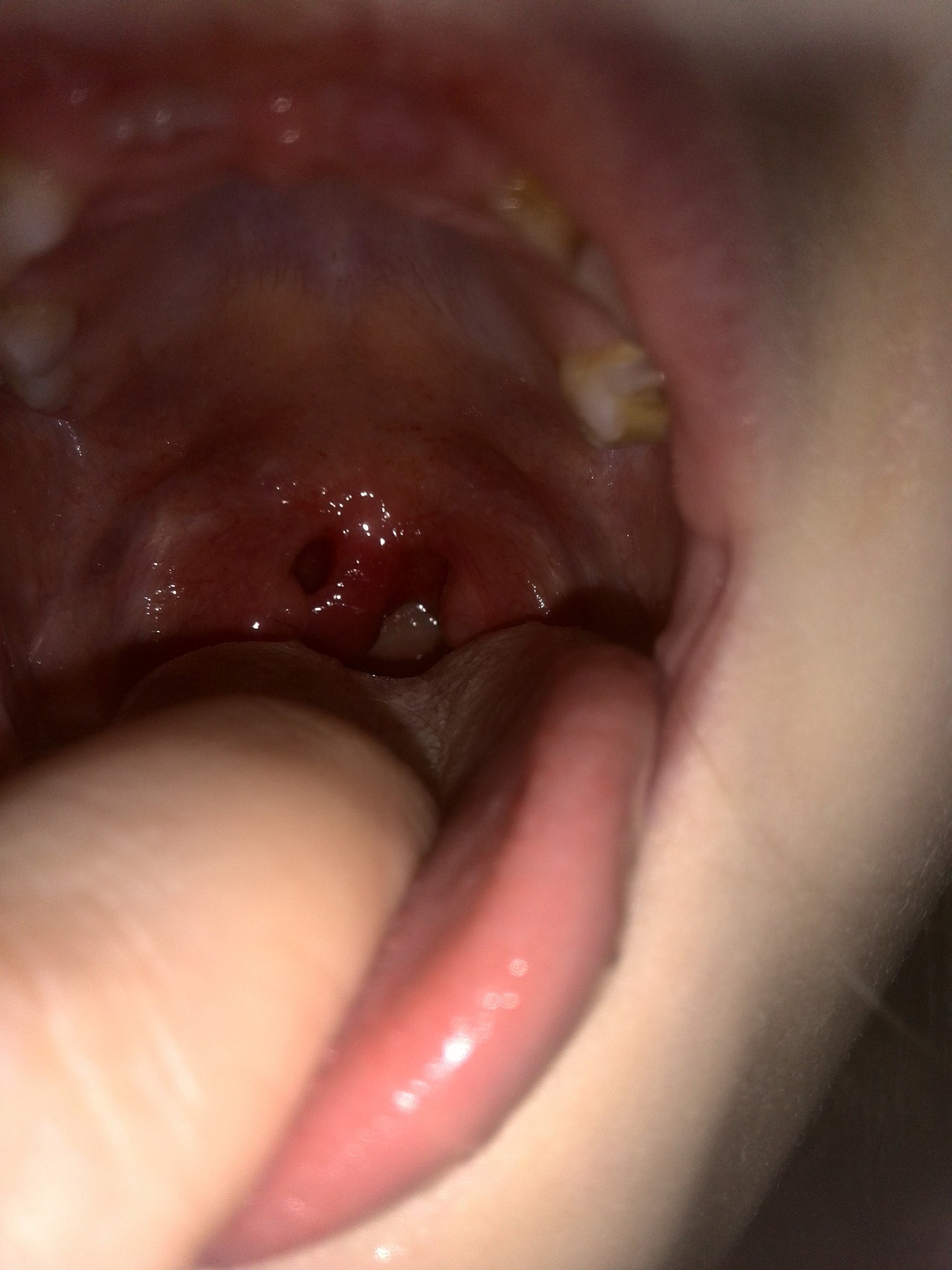 Нёбный язычок прилип к нёбной миндалине — МедВопрос и консультация врача на форуме