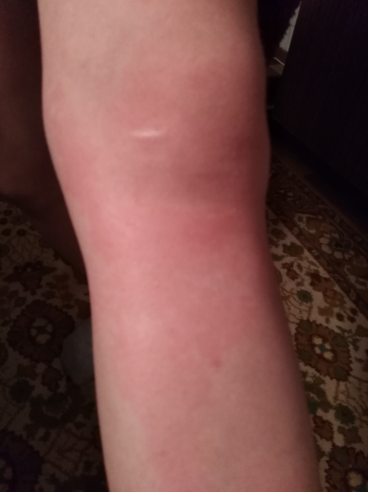 Высыпания на ногах пятна красные и исчезают Вопрос