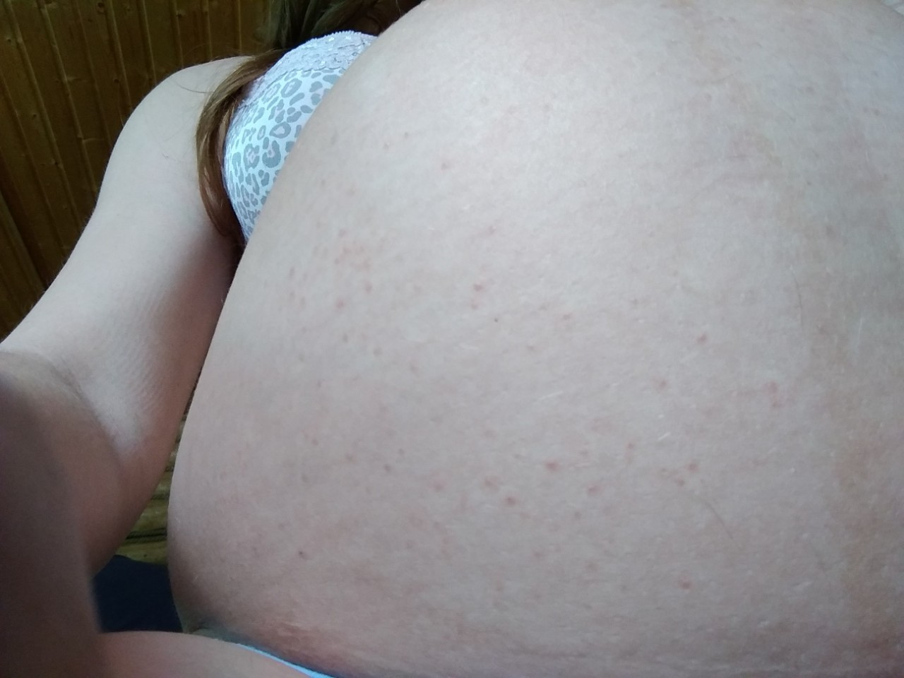 красная сыпь на груди во время беременности (120) фото