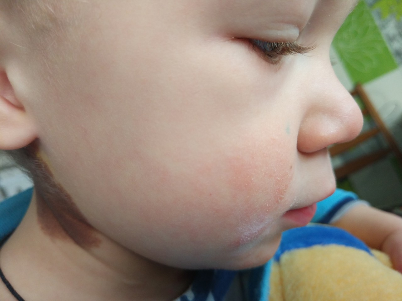 Красные шершавые щеки у ребенка