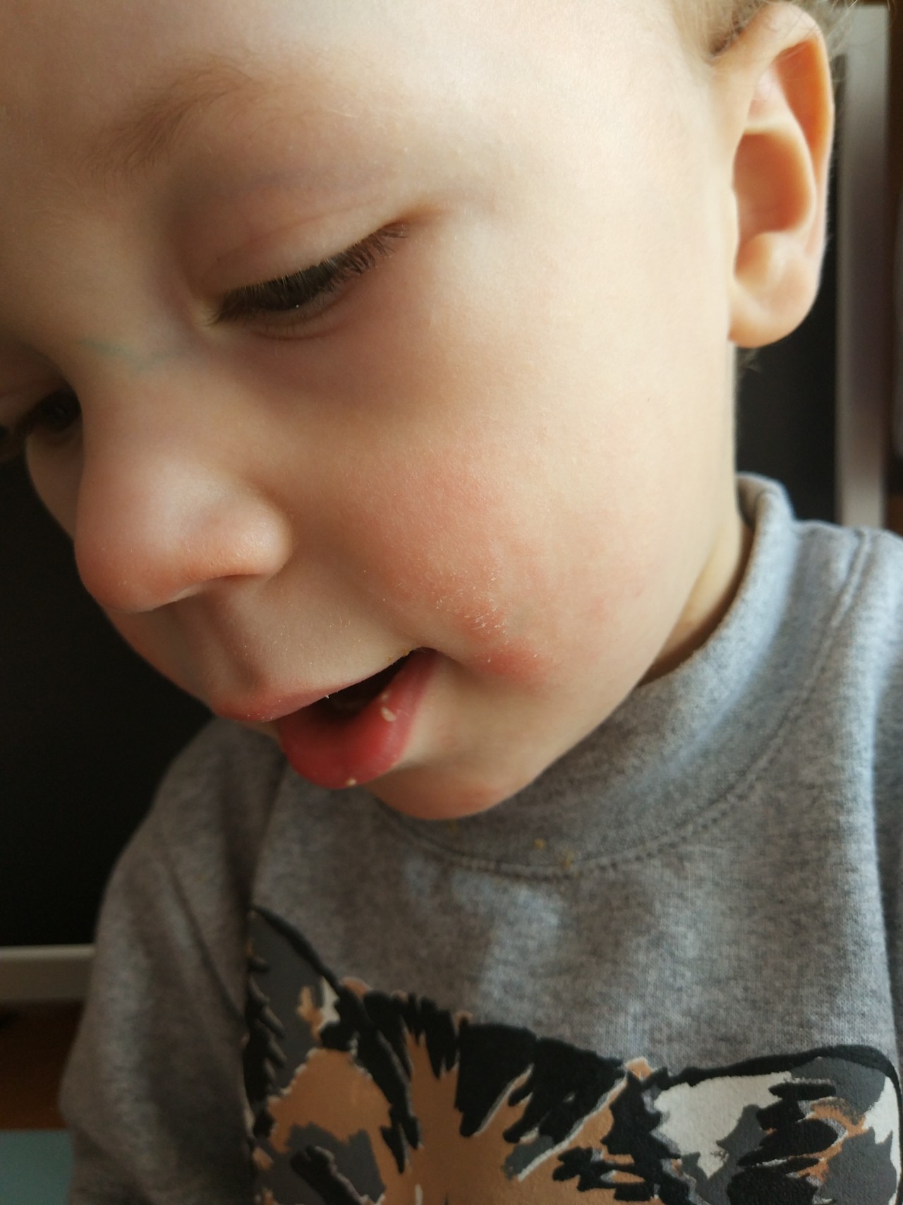 Ребенку год красные щеки. Красные щечки у ребенка 2 года. У ребенка красные щеки и шелушатся.