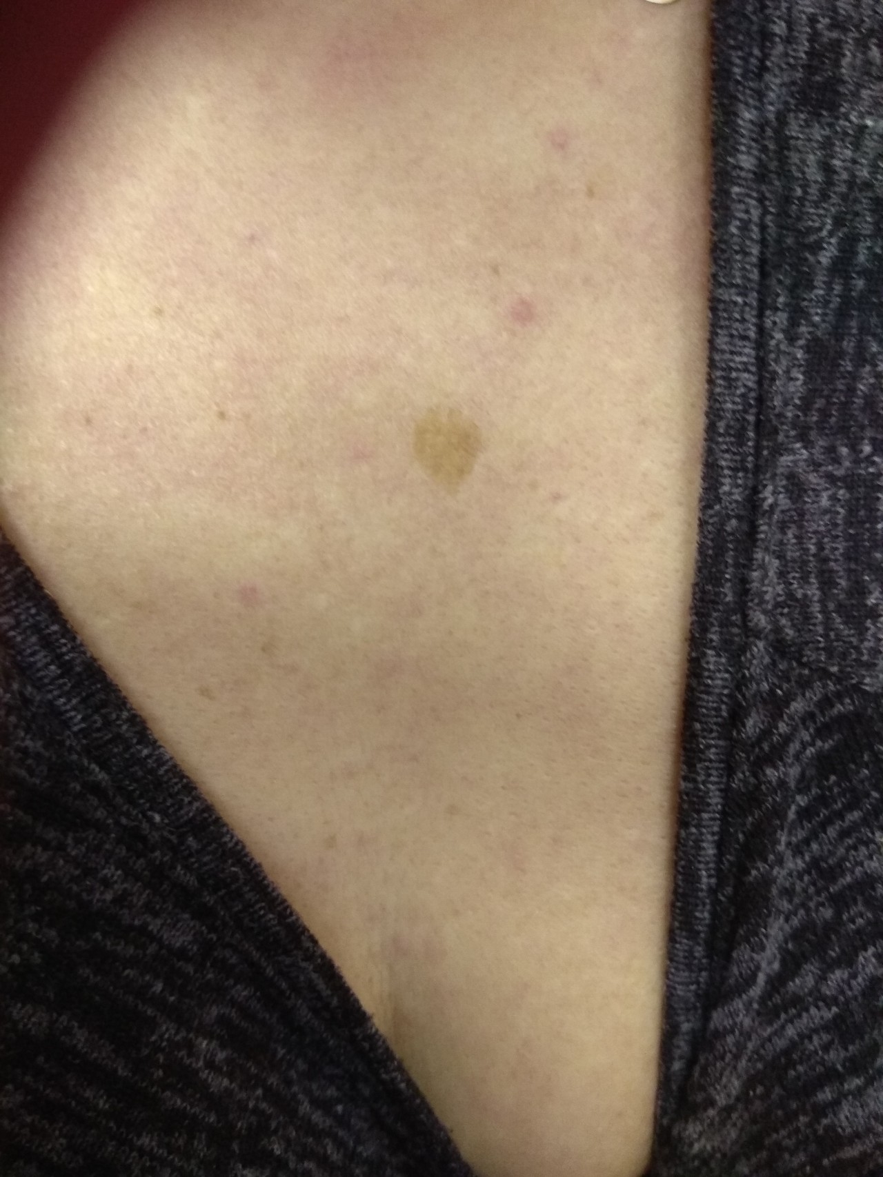 светло коричневые пятна на груди у женщин фото 69