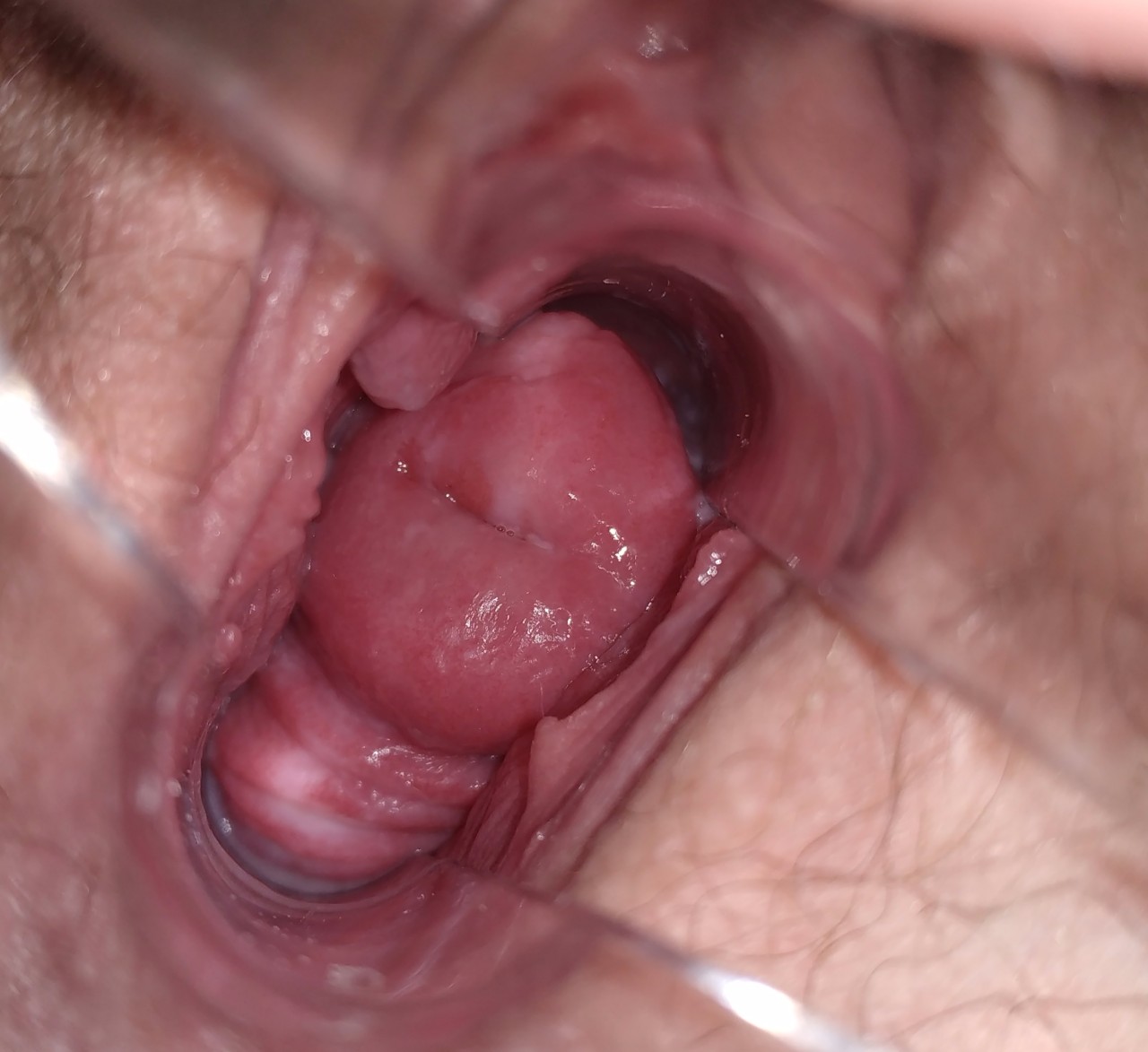 рак матки от спермы фото 16