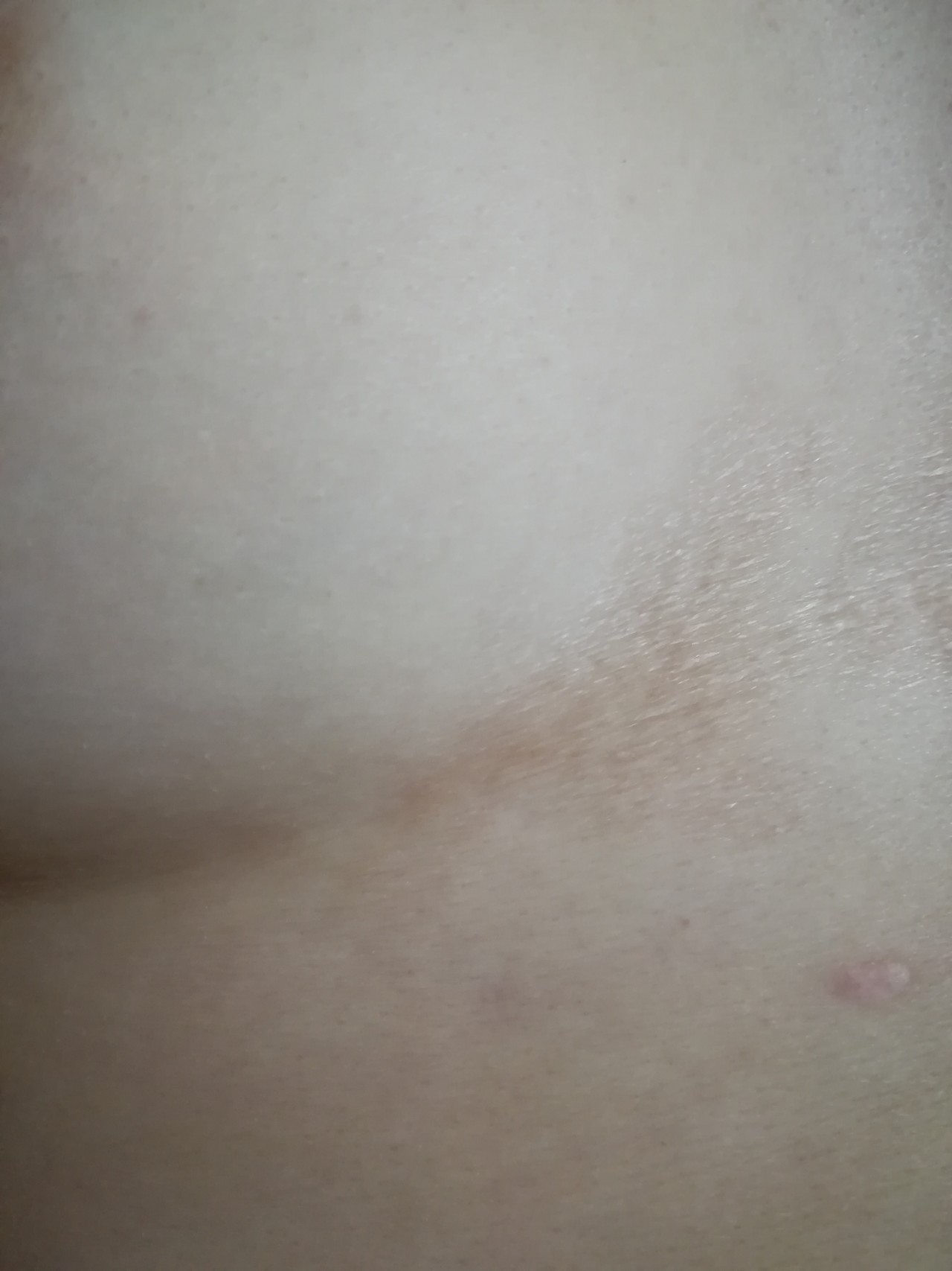 дерматит под грудями фото фото 105