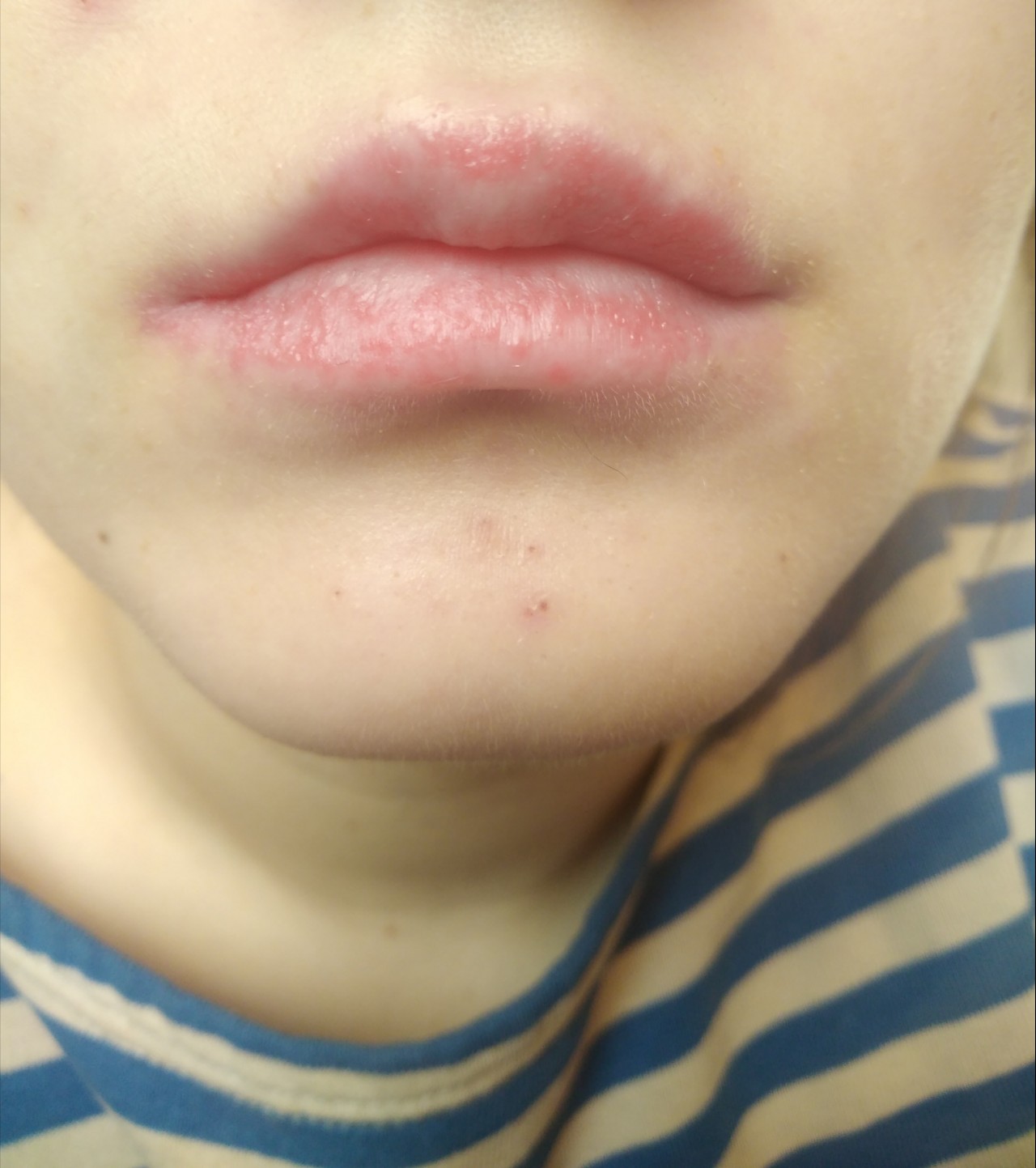 Белая сыпь в виде манной крупы на губах: причины высыпания, лечение у ребенка и взрослого