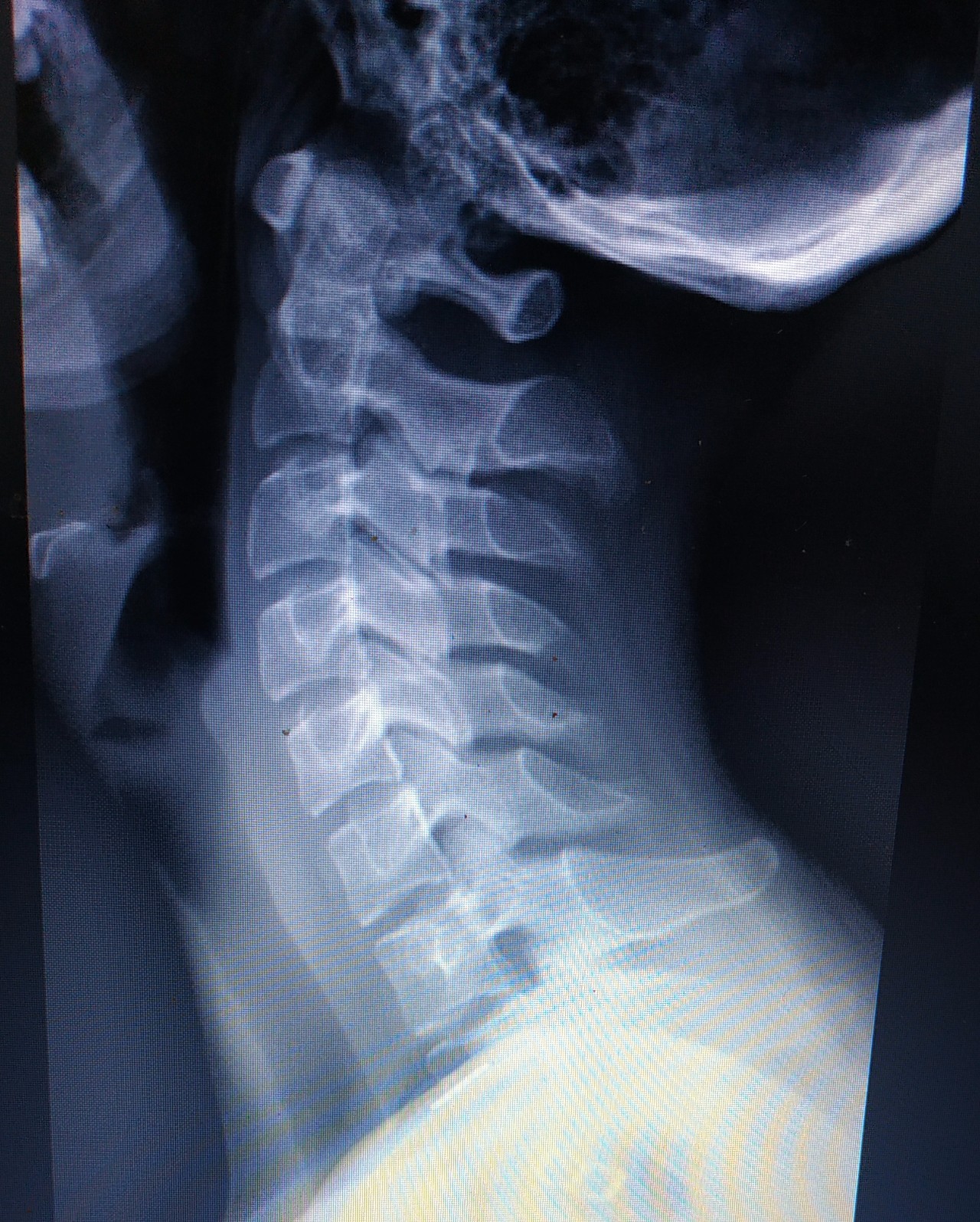 Рентген шейного позвоночника. Рентген здорового позвоночника сбоку. Поясничный отдел позвоночника рентген норма. Шейный отдел позвоночника рентген норма. Рентген поясничного отдела позвоночника.