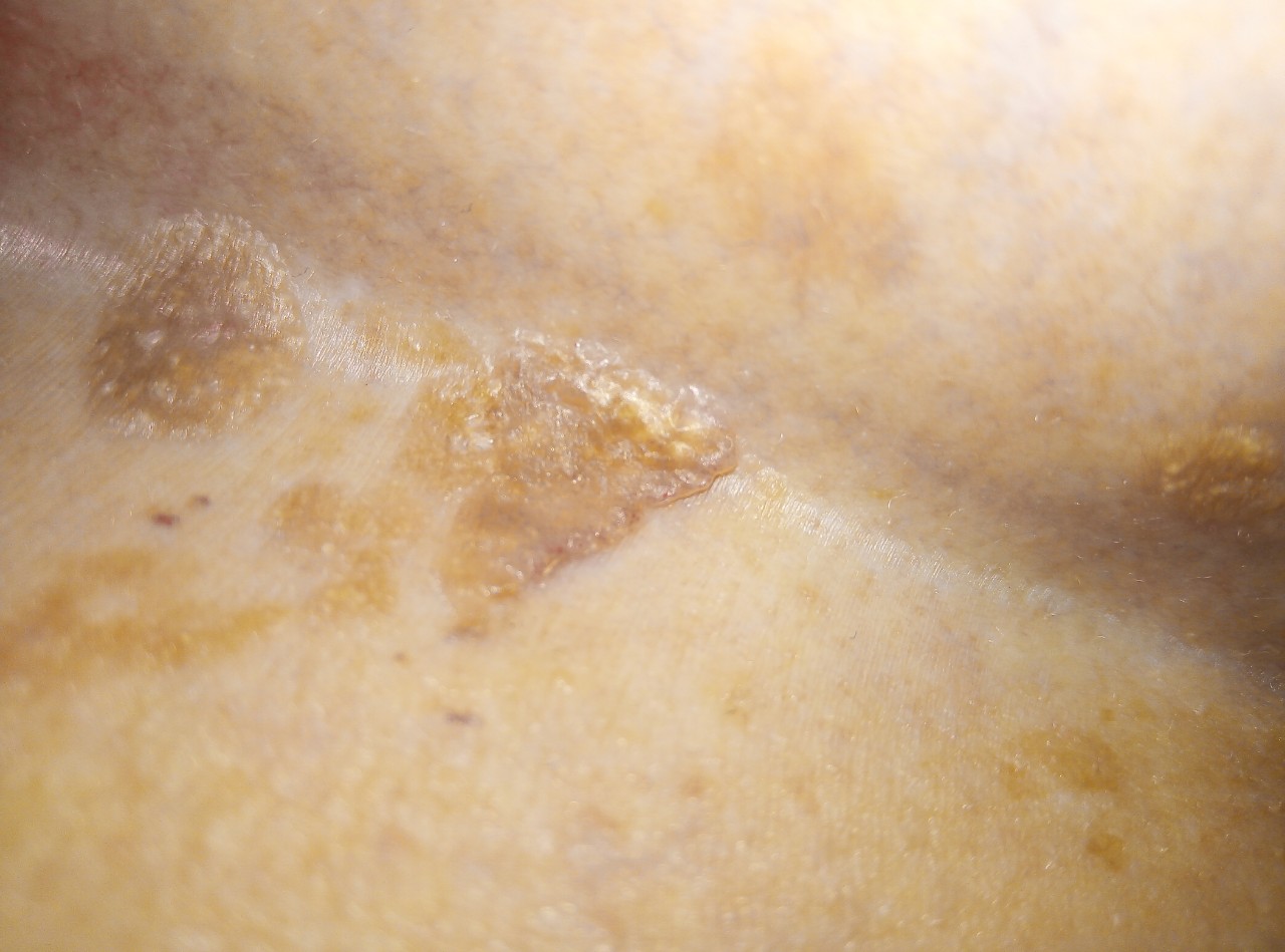 коричневые пятна на груди беременность фото 100