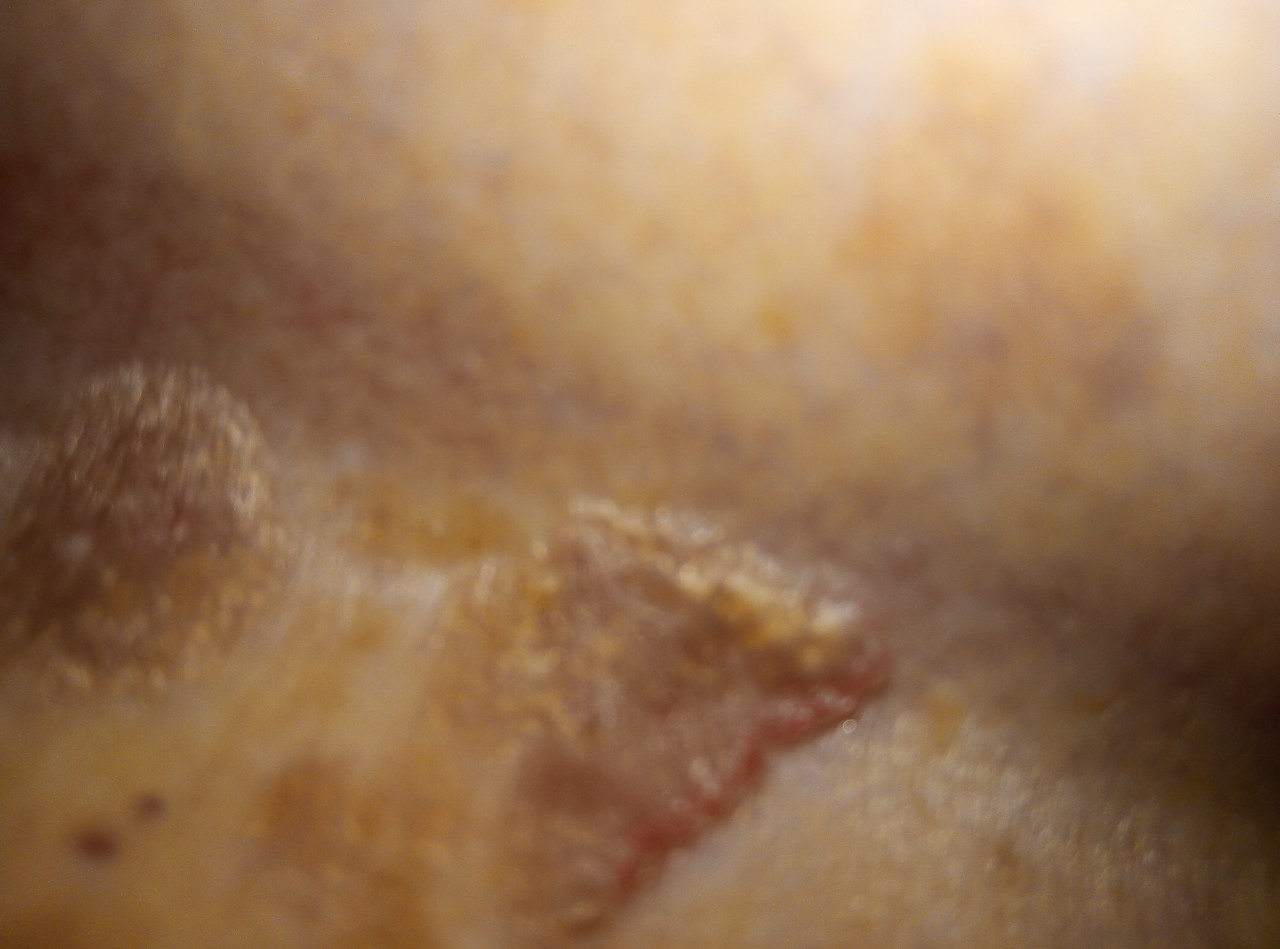 красное пятно на груди во время беременности фото 16