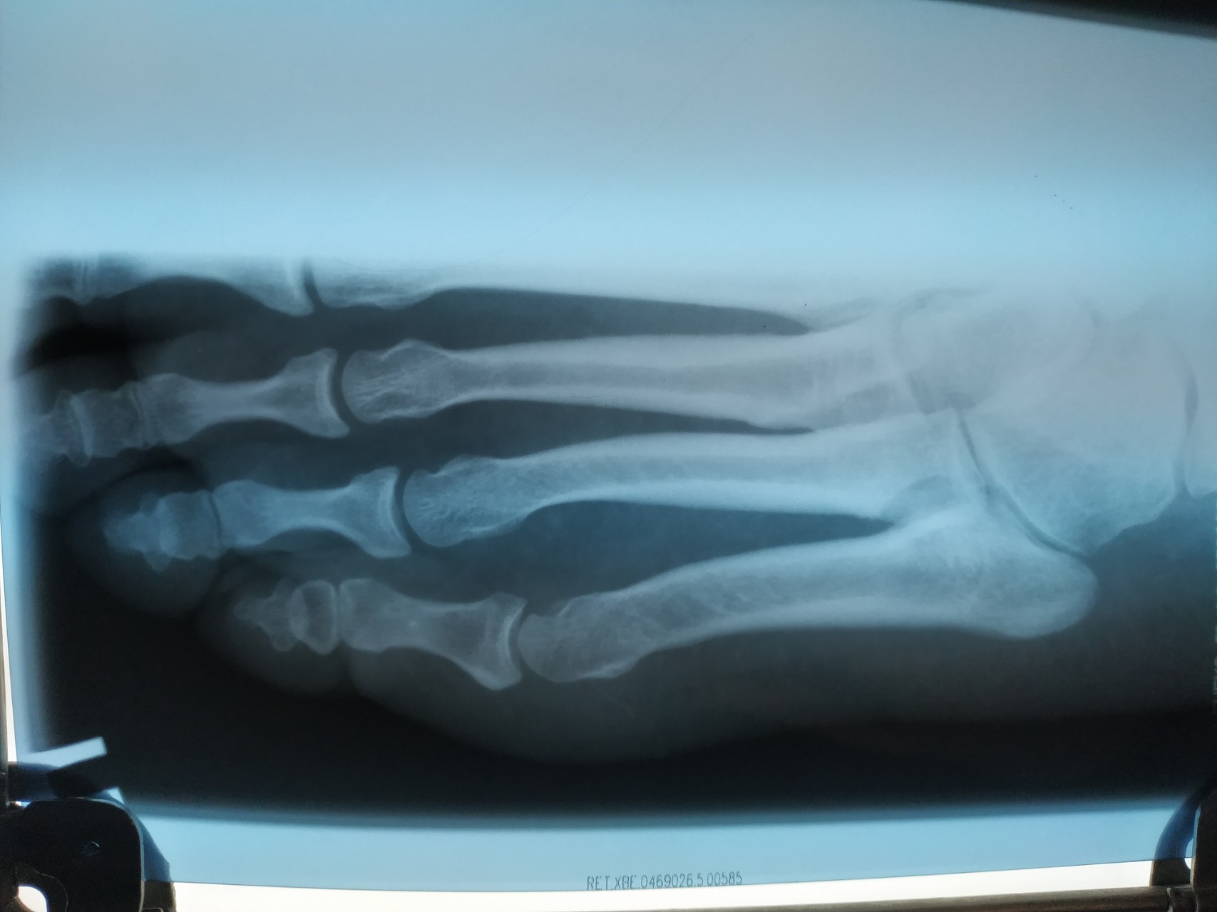 Перелом джонса 5 плюсневой кости фото