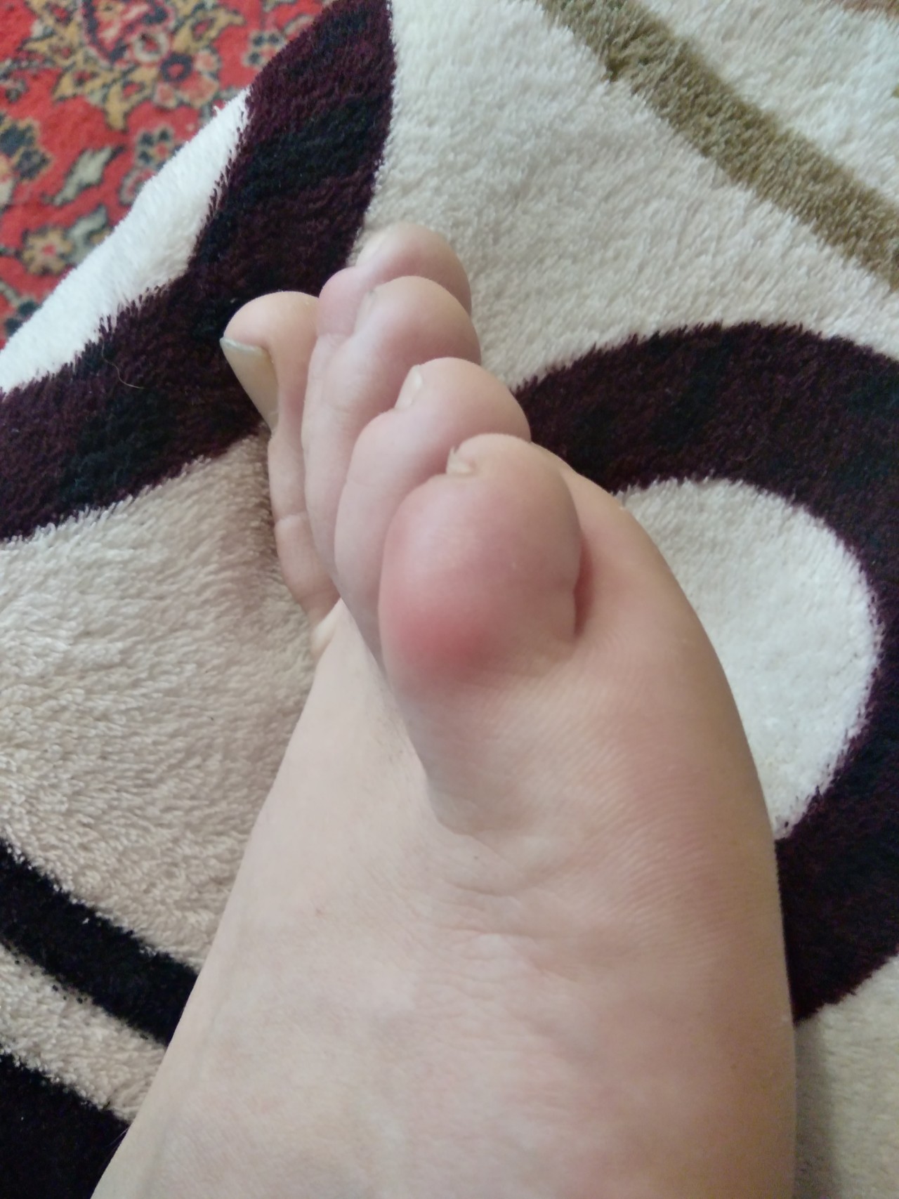 фото ушибленного пальца на ноге