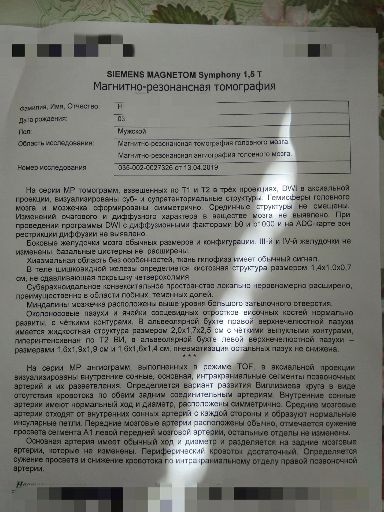 Мра картина варианта развития виллизиева круга в виде снижения кровотока и сужения просвета по обеим