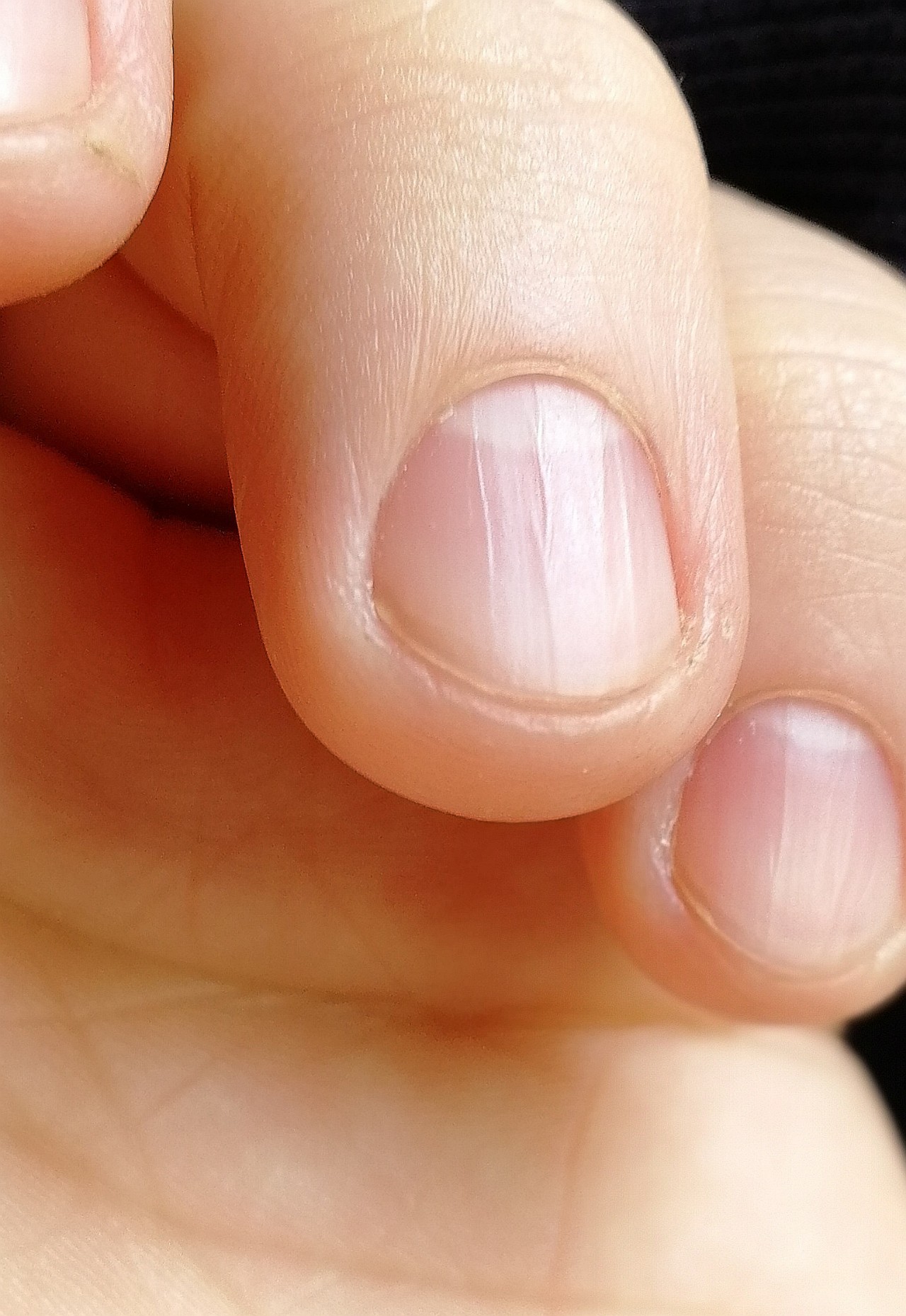 Почему ногти стали тоньше. Литеральный онихолизис. Ногтевая пластина.
