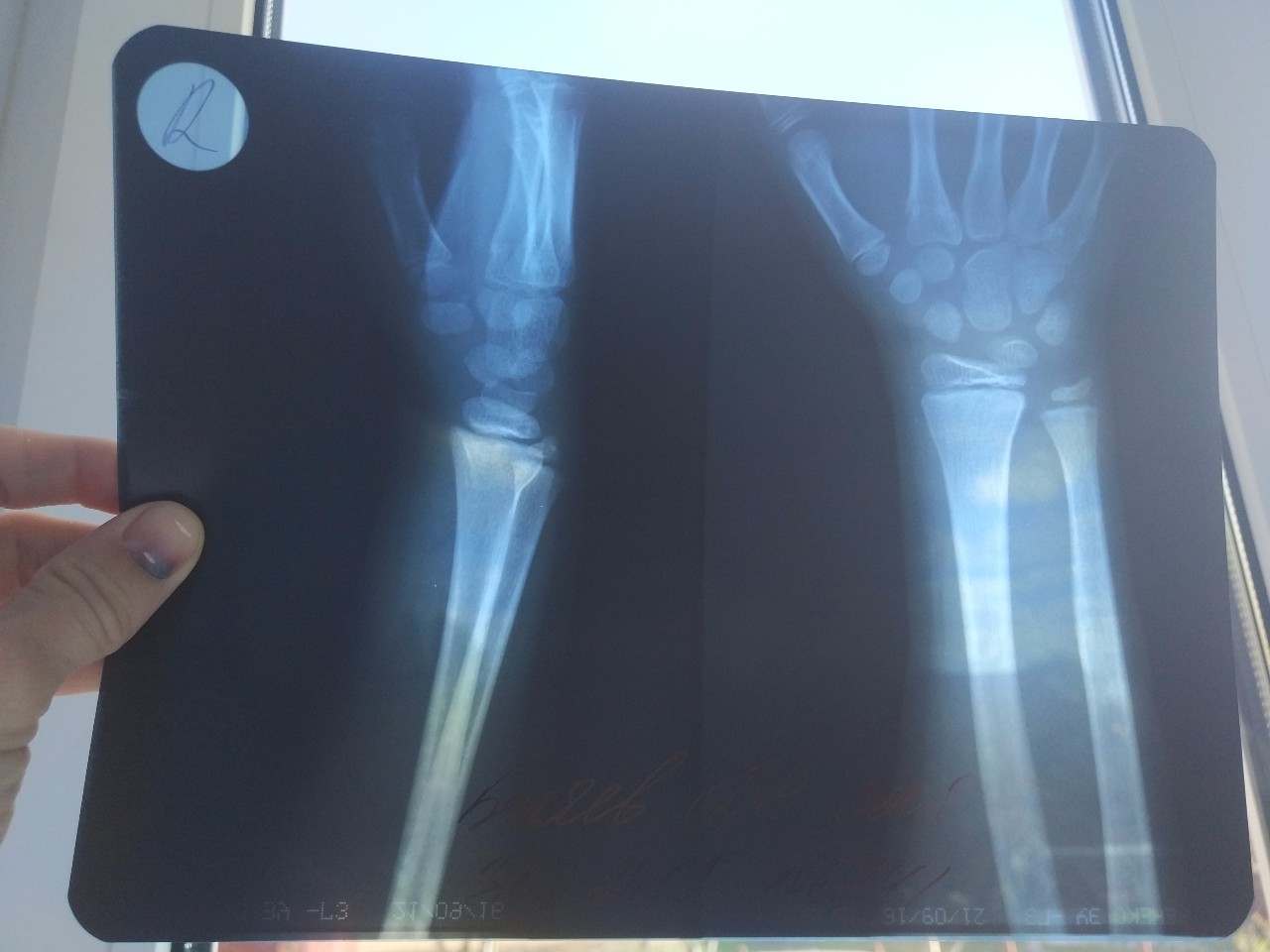 Снимок трещины. Рентгеновский снимок руки. Рентгеновский снимок перелома руки.
