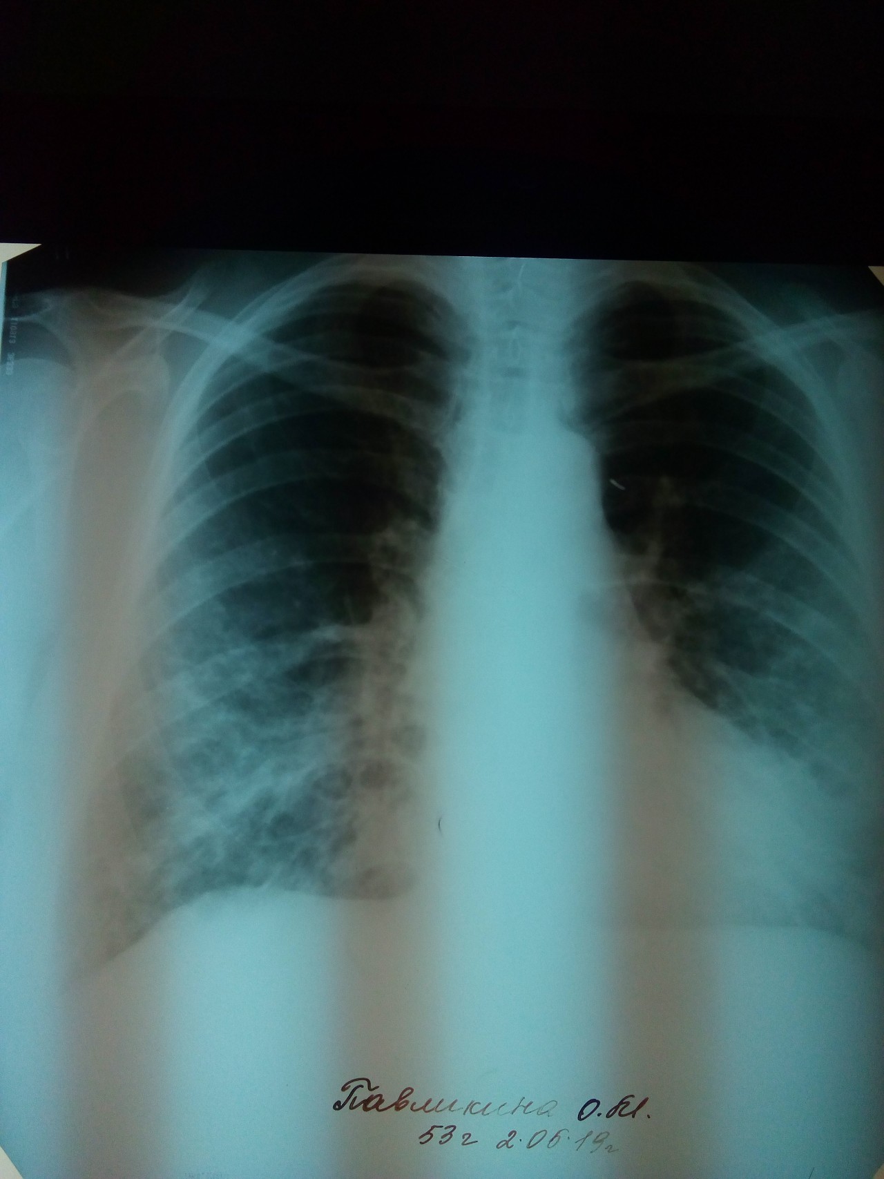 Бронхопневмония на рентгенограмме. Бронхопневмония рентген. Бронхопневмония и бронхит. Пневмосклероз легких фото.