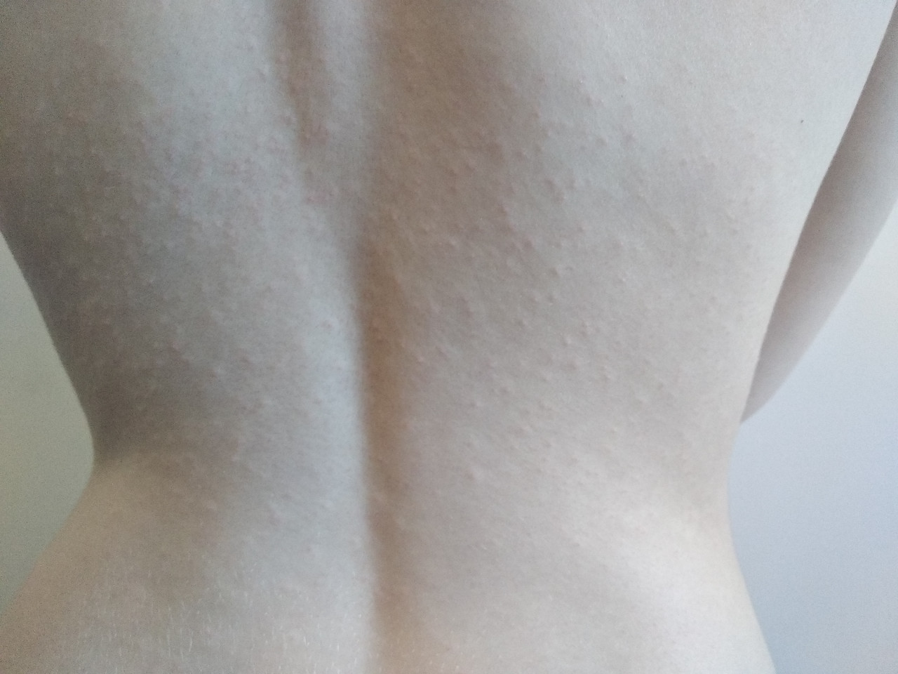 сыпь на спине и груди у женщин фото 68
