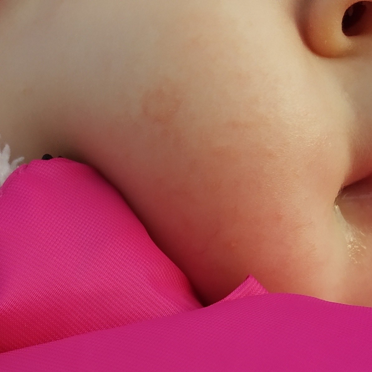 Сухое пятнышко на лице у ребенка 8 месяцев
