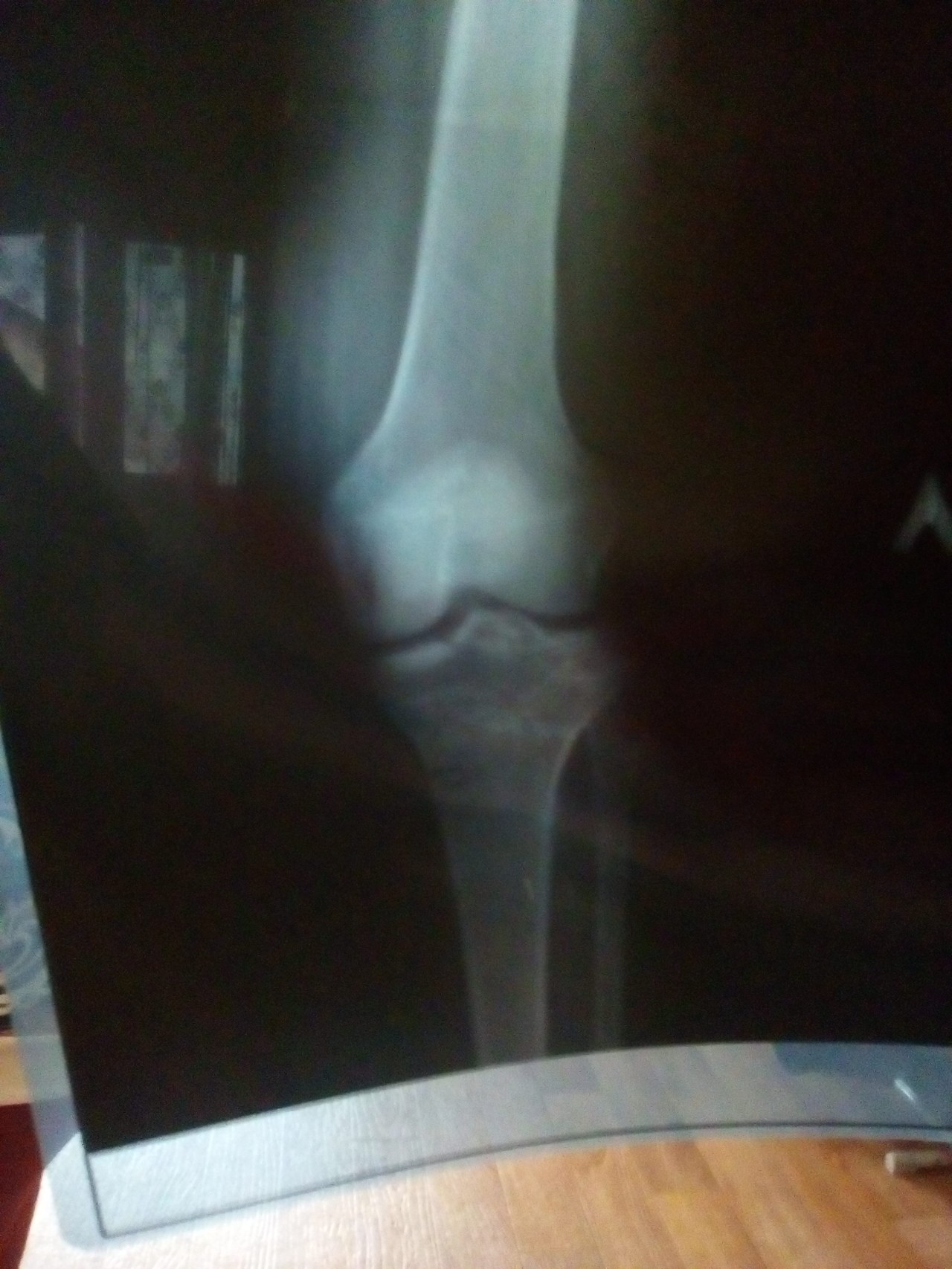 Трещина в коленной. Перелом чашечки коленного сустава рентген. Перелом коленного сустава рентген. Перелом коленной чашечки рентген. Ушиб коленной чашечки рентген.