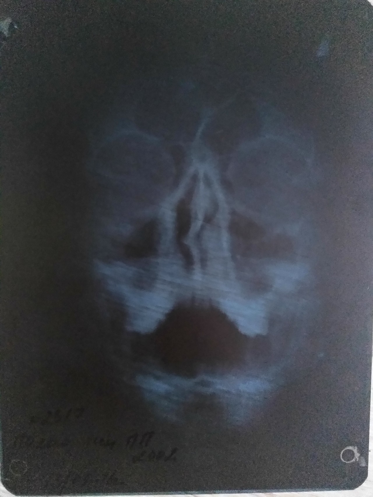 Искривление носовой перегородки влево рентген
