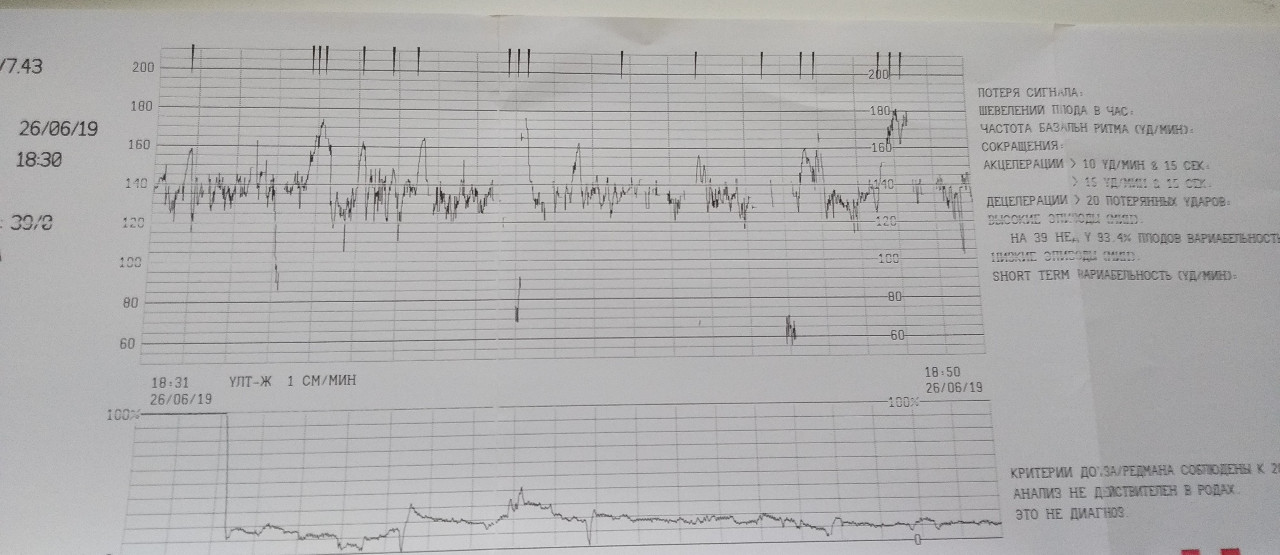 Ктг на 39 неделе беременности