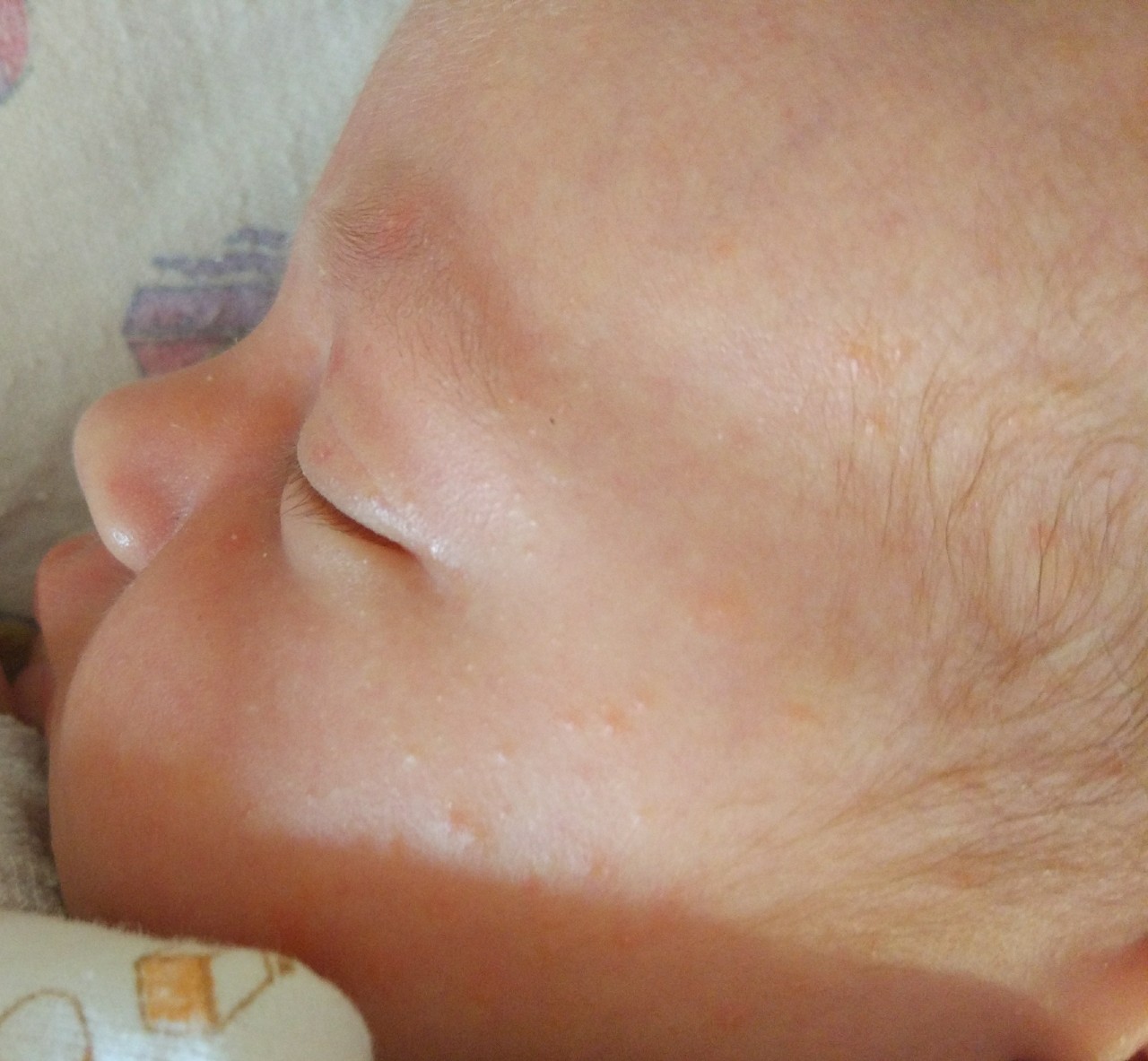 медиальные пятна новорожденных фото