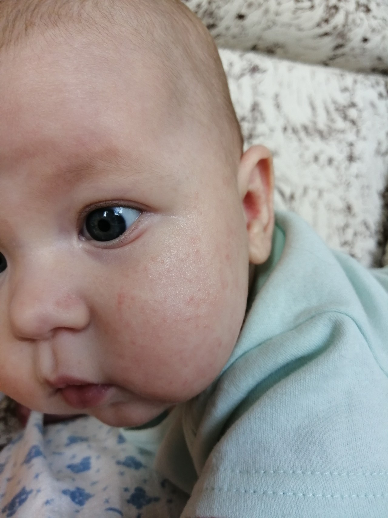 Атопический дерматит на щеках у ребенка