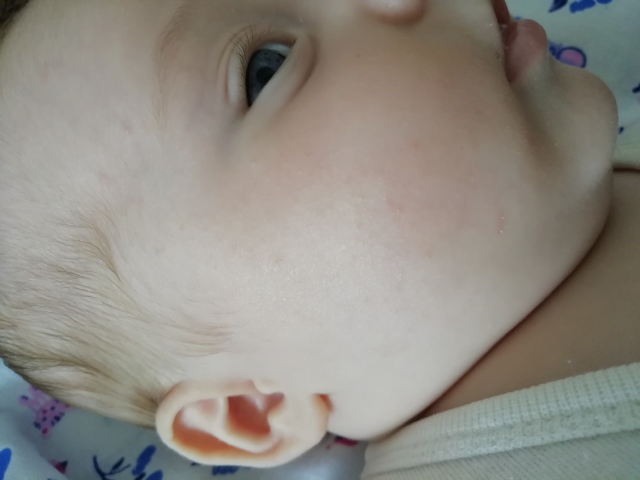 Высыпания на лице у младенца