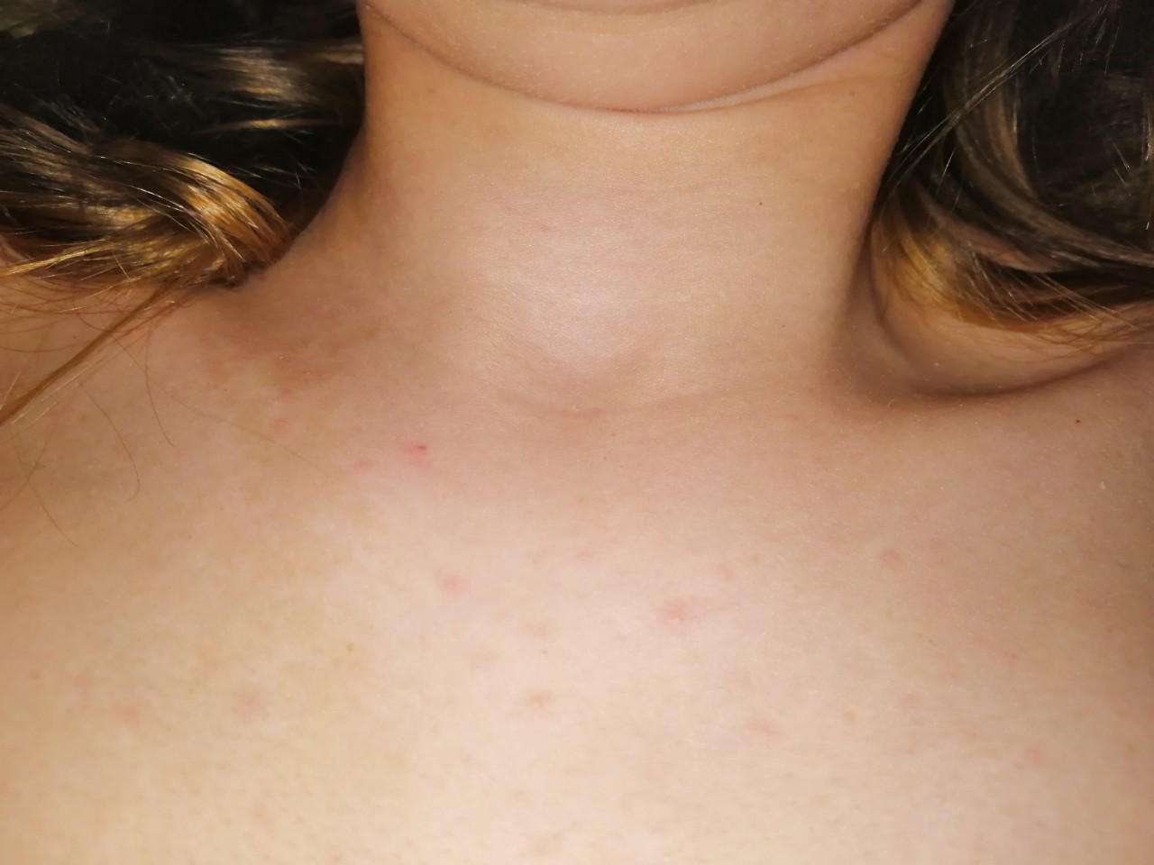 сыпь на лице и груди у женщин фото 34