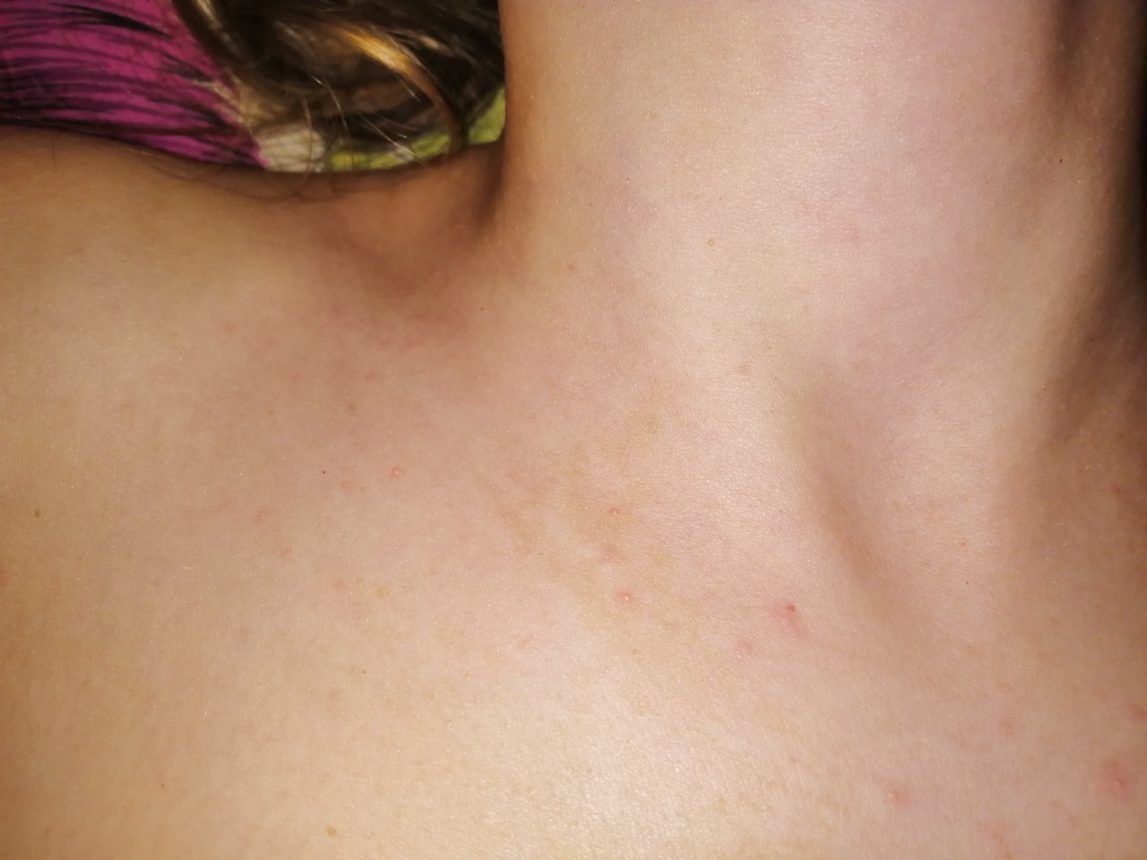 сыпь на спине и груди у женщин фото 102