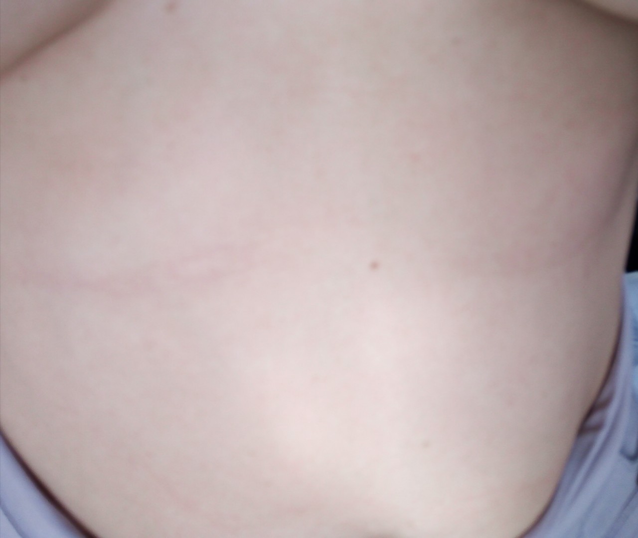 гнойная шишка на груди у женщин фото 100